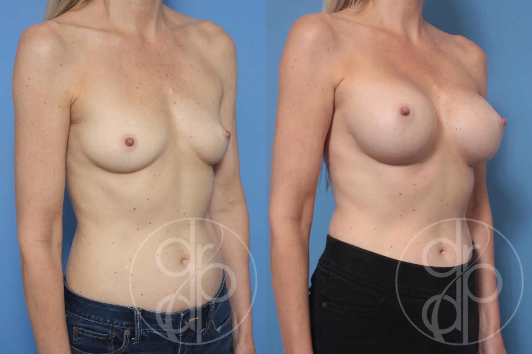 patient 10351 breast augmentation before and after result - Before and After 2