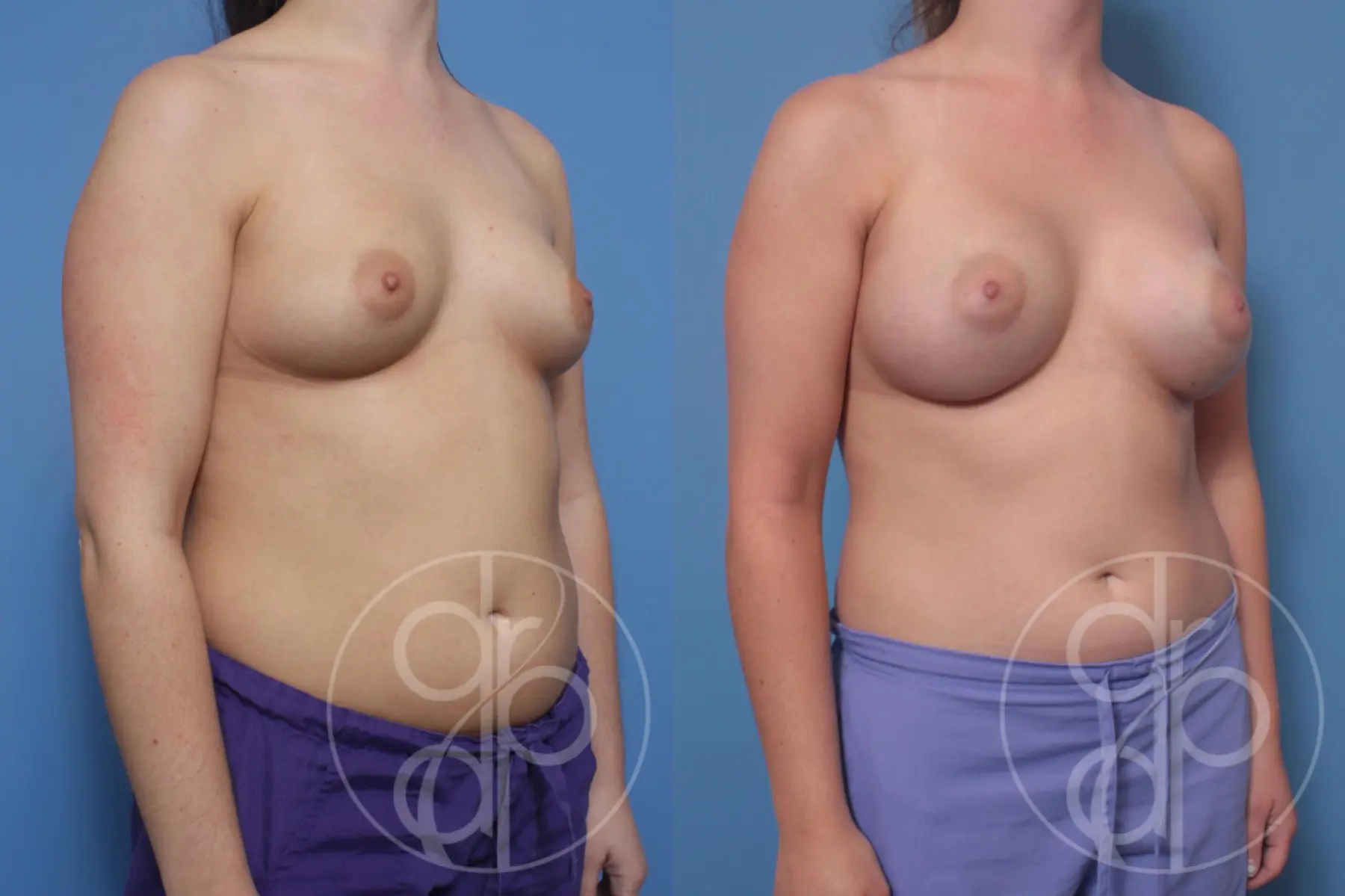 patient 10121 breast augmentation before and after result - Before and After 4