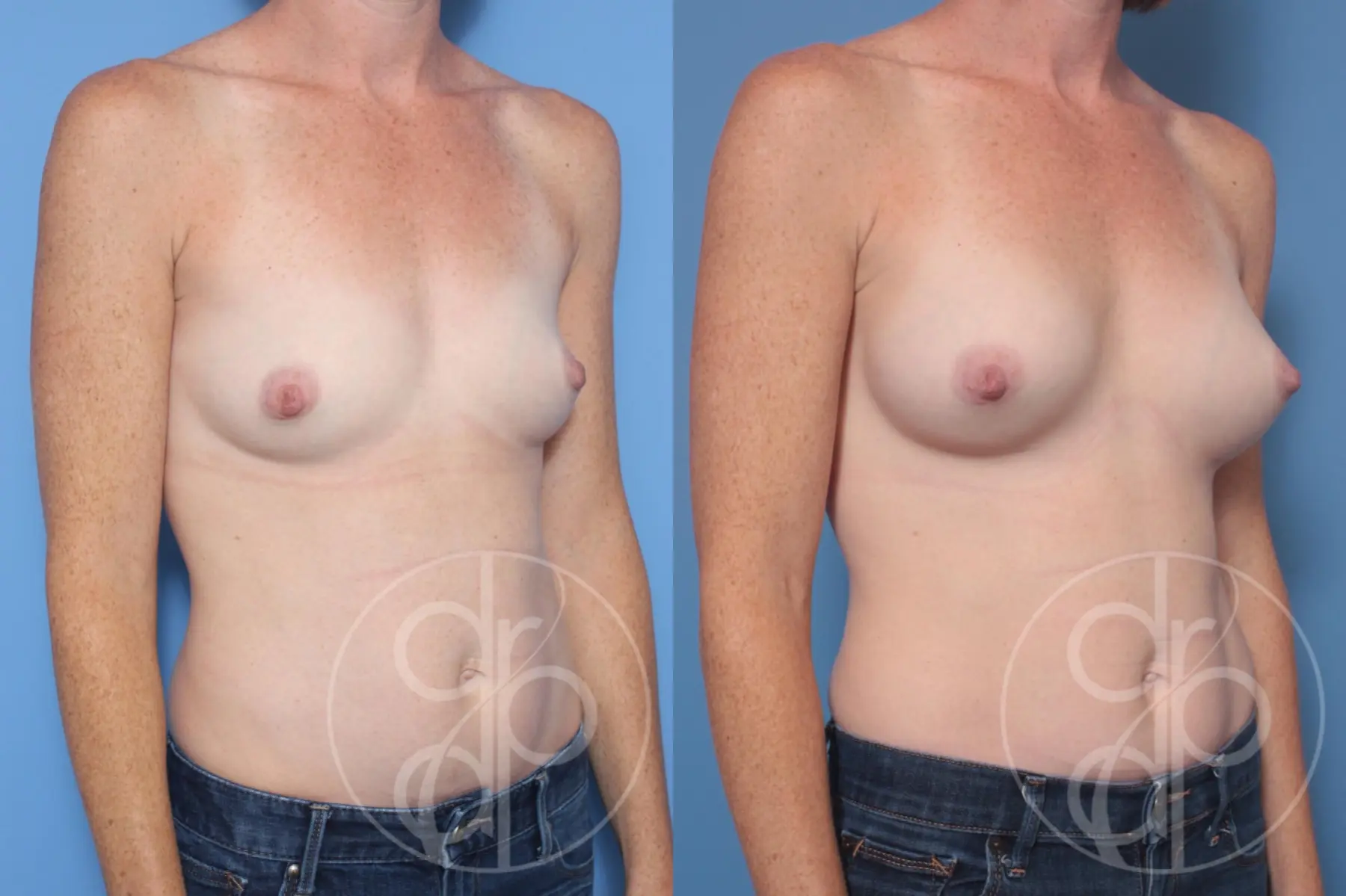 patient 10437 breast augmentation before and after result - Before and After 2