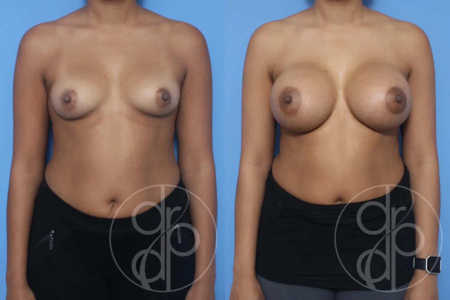 patient 10131 breast augmentation before and after result - Before and After 1