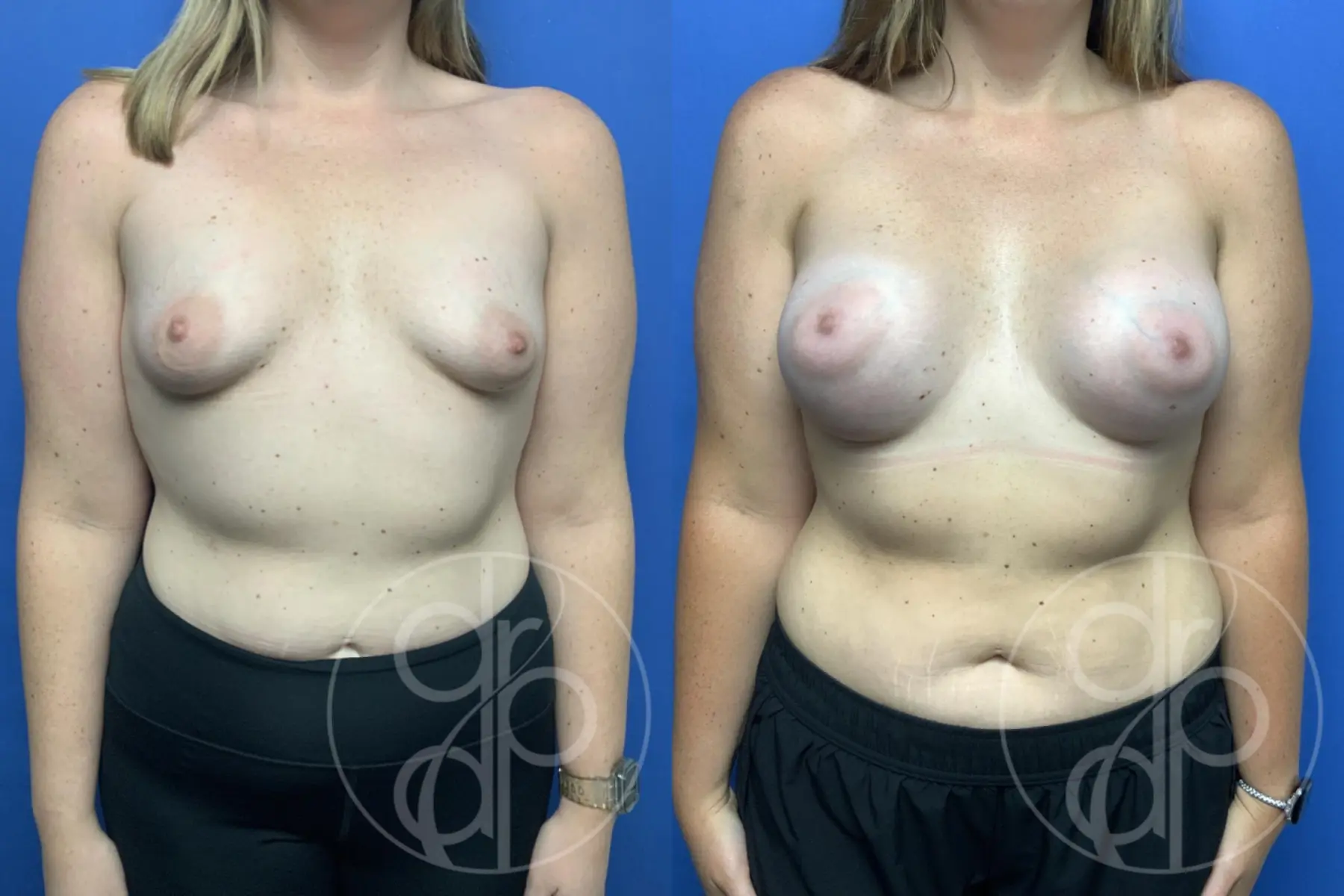patient 12207 breast augmentation before and after result - Before and After 1