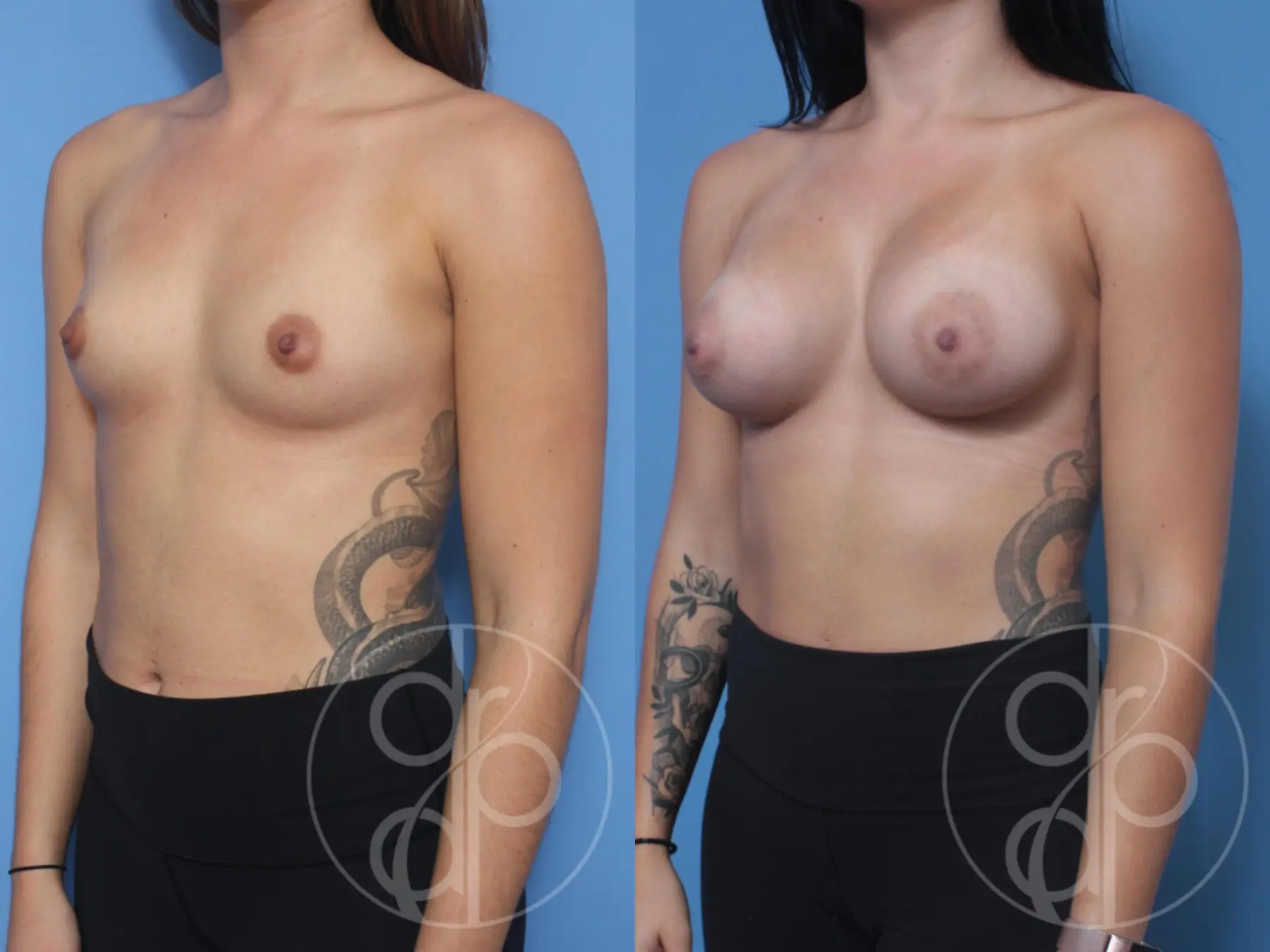 patient 10289 breast augmentation before and after result - Before and After 3