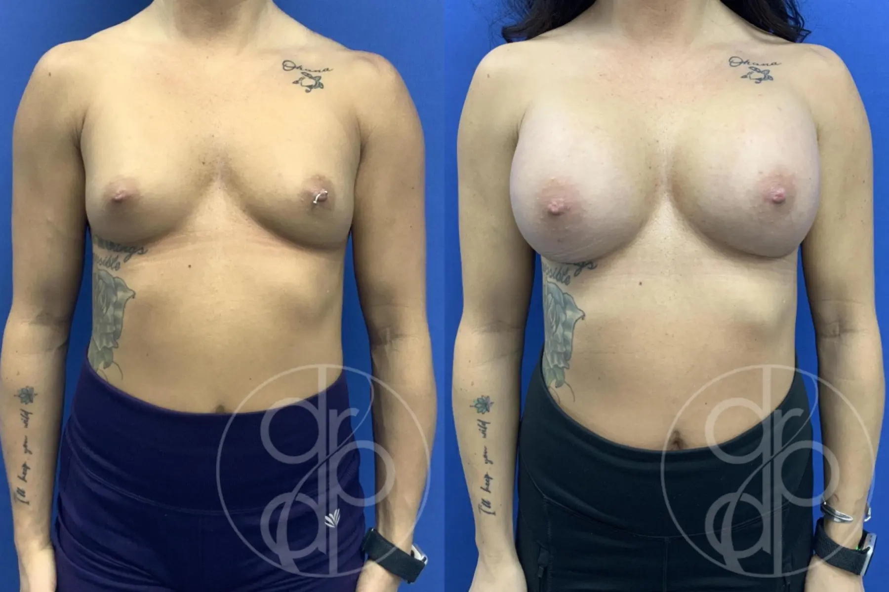 Breast Augmentation: Patient 3 - Before and After  