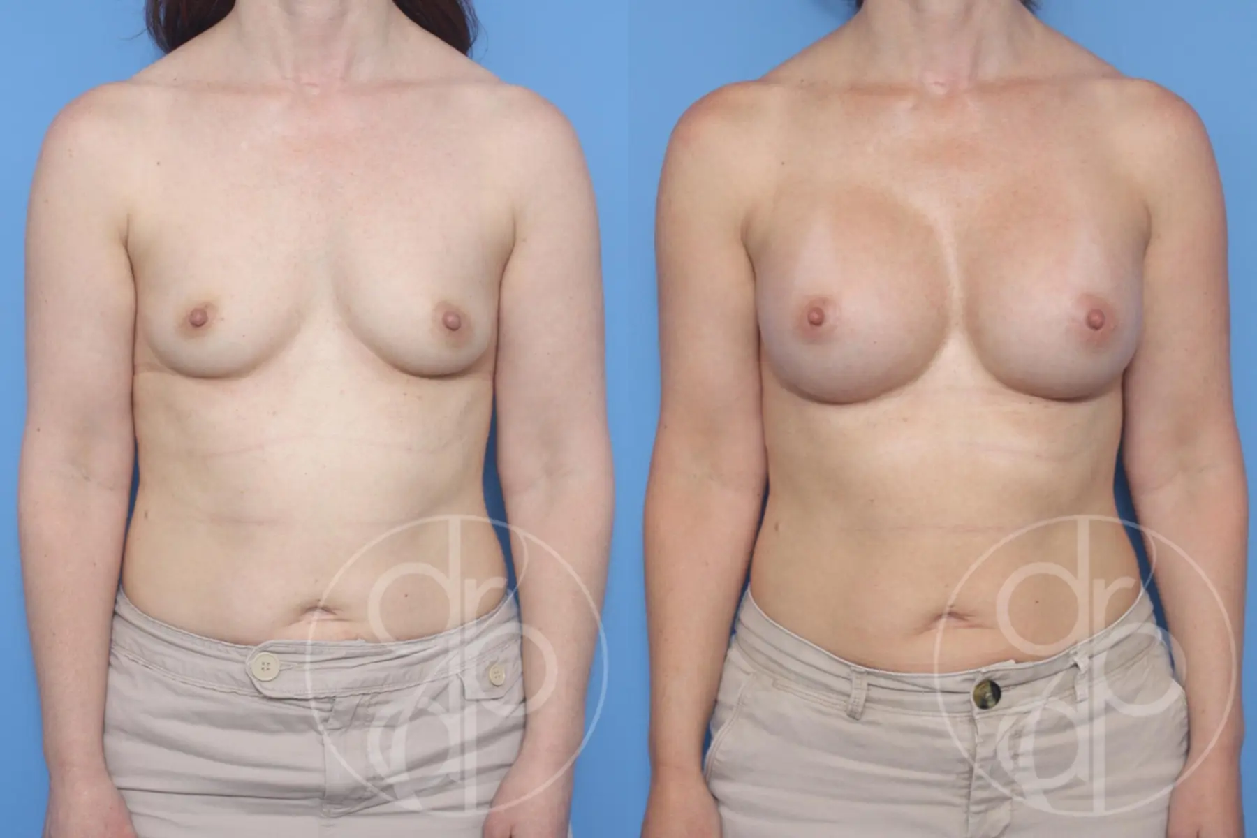 patient 13300 breast augmentation before and after result - Before and After 1