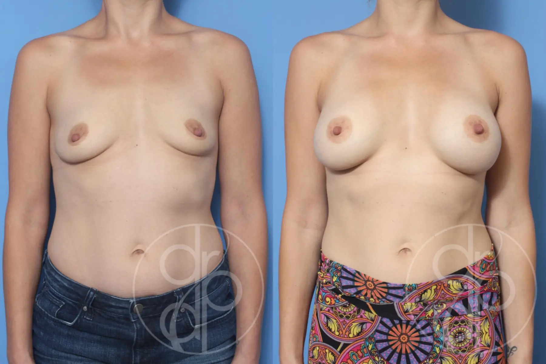 patient 11825 breast augmentation before and after result - Before and After 1