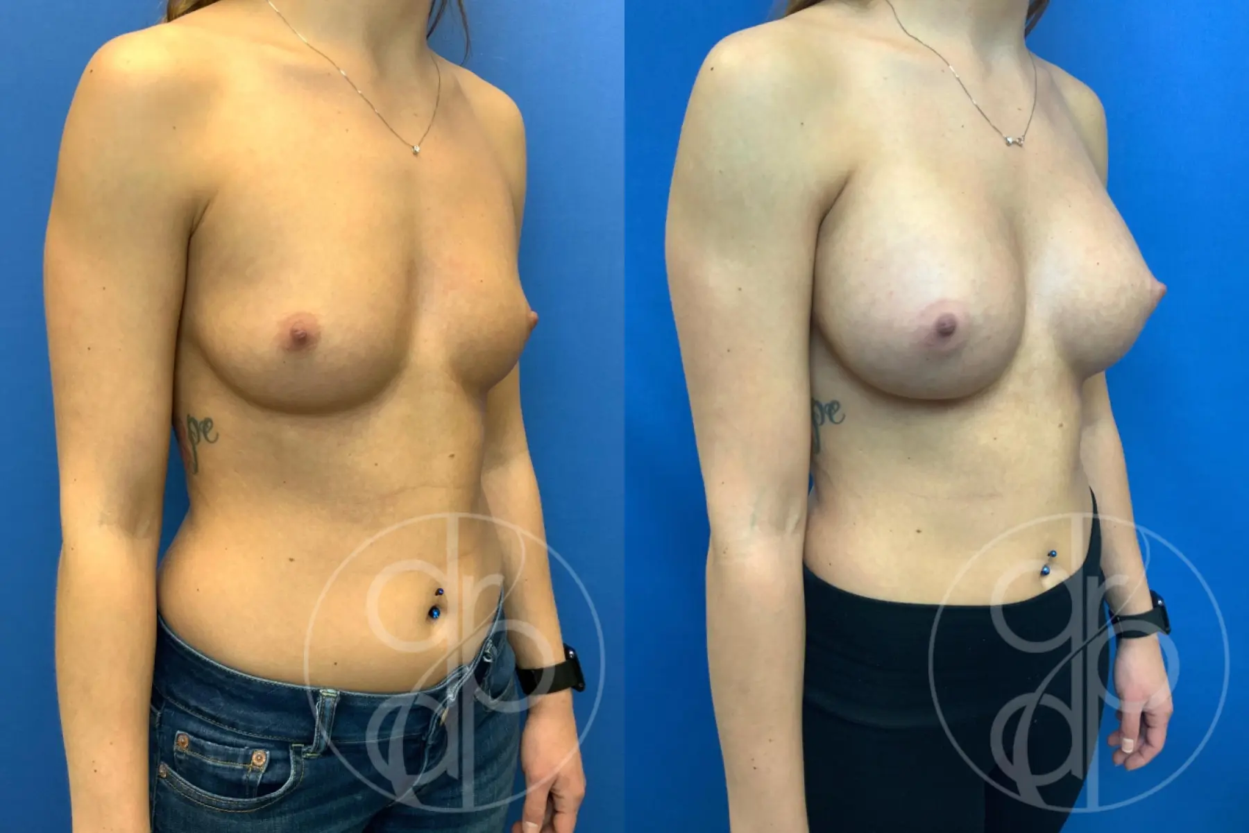 patient 10657 breast augmentation before and after result - Before and After 2