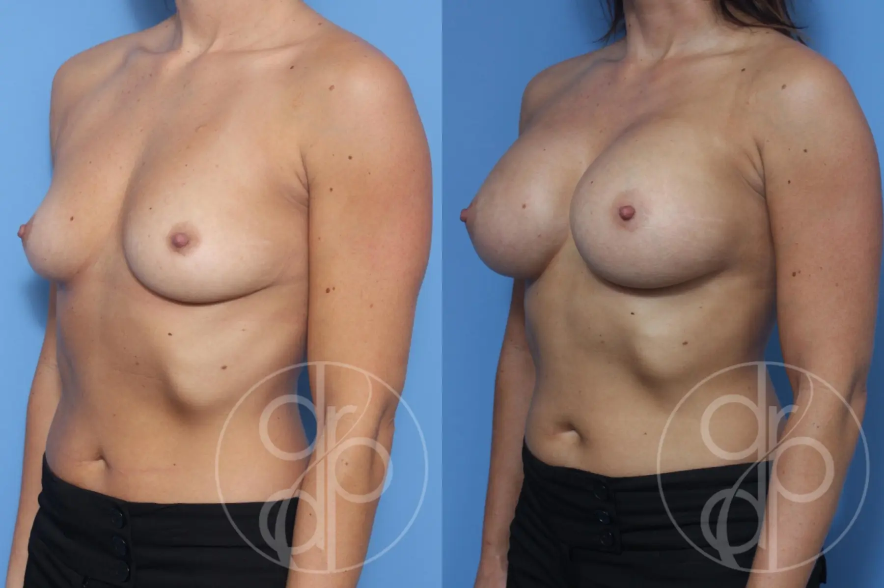patient 13184 breast augmentation before and after result - Before and After 2