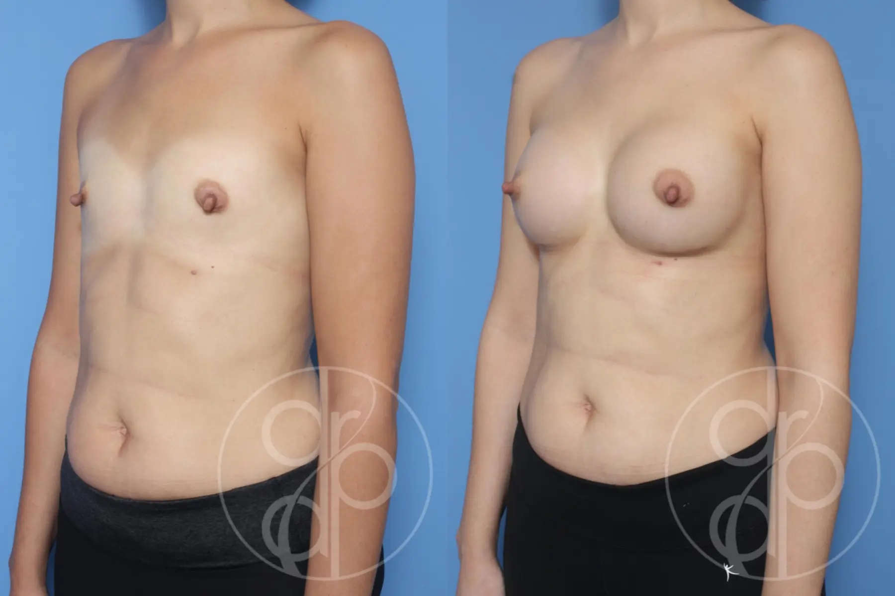 patient 12869 breast augmentation before and after result - Before and After 3