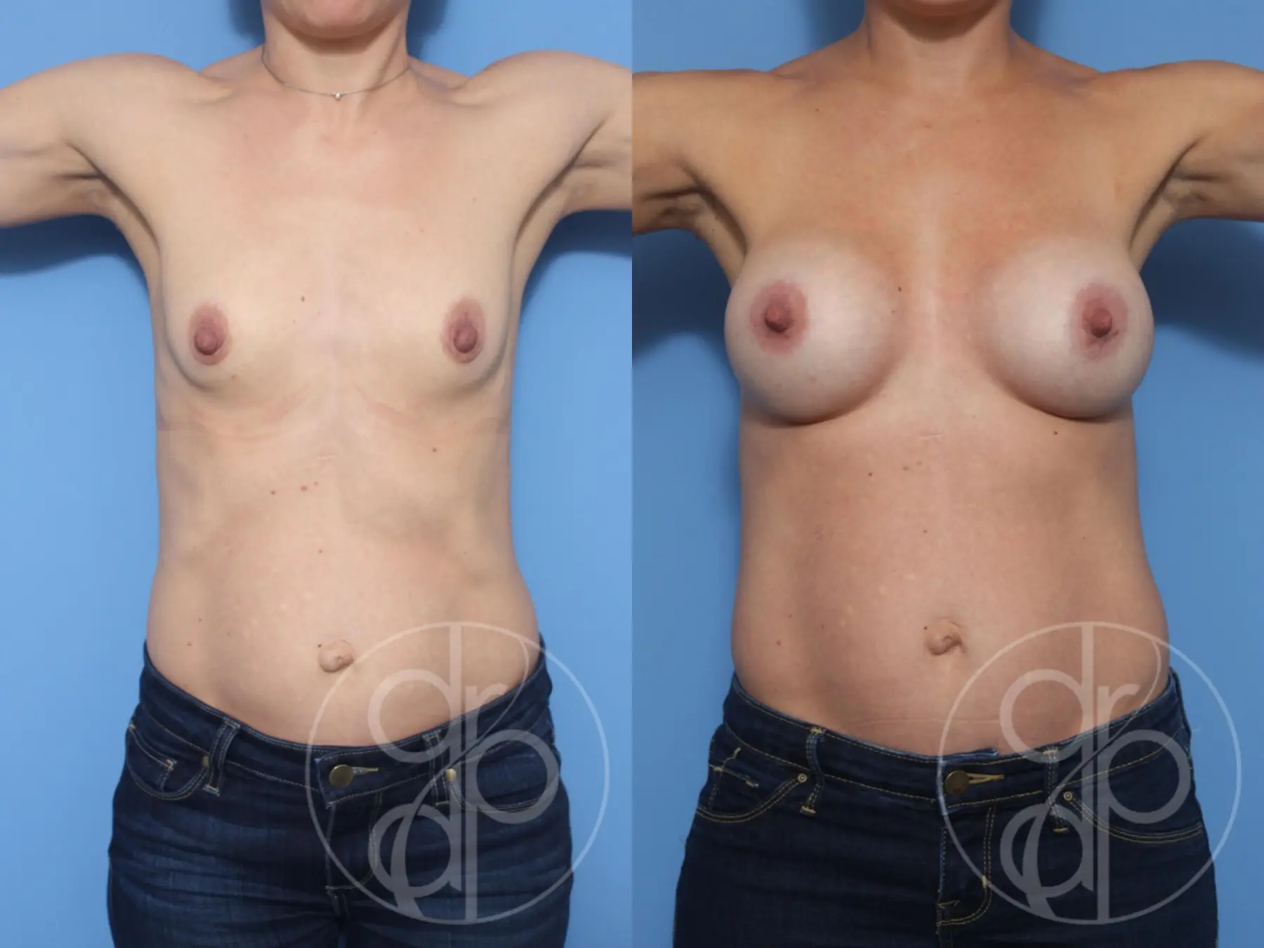 patient 13216 breast augmentation before and after result - Before and After 2