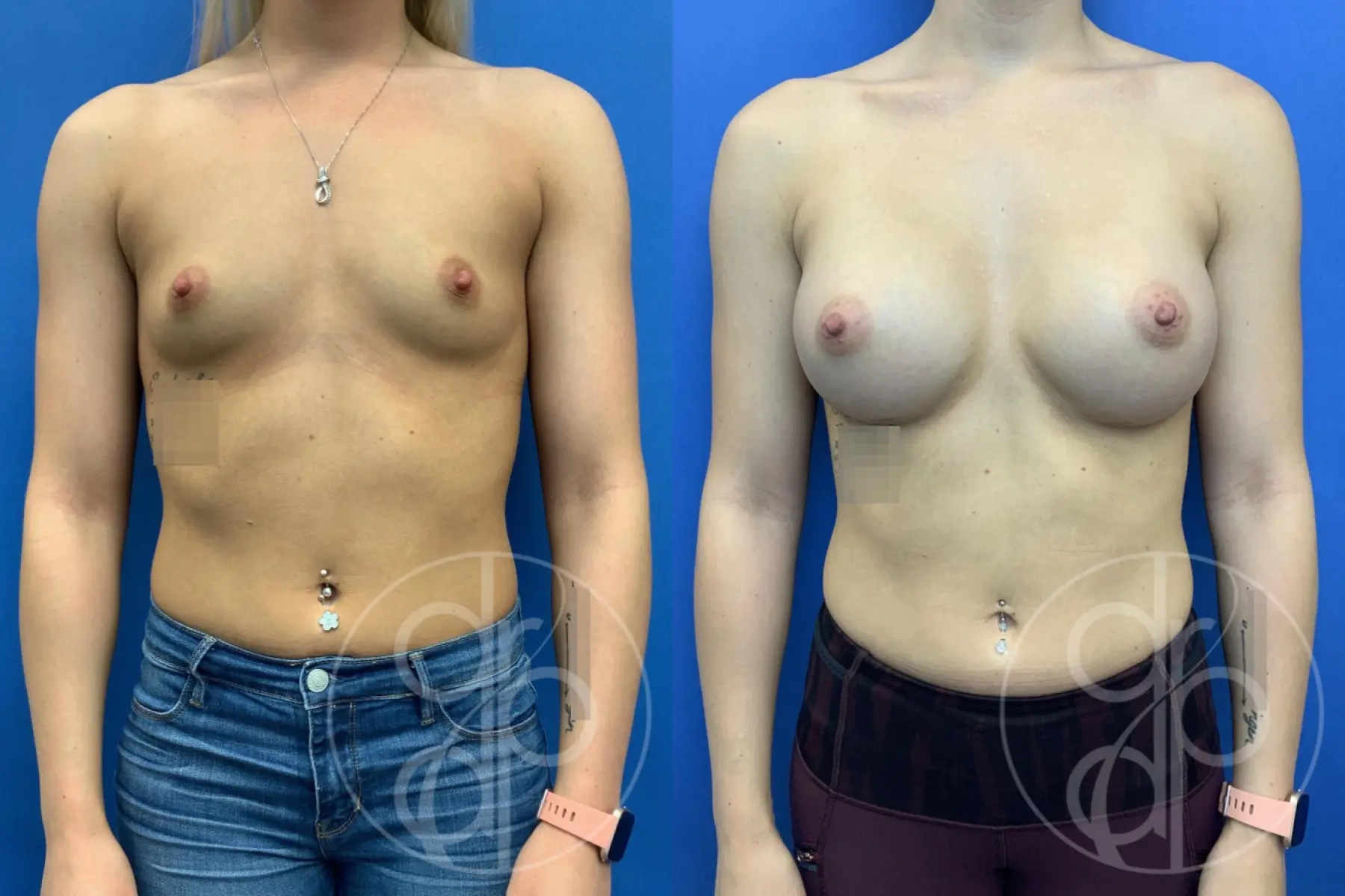 patient 10726 breast augmentation before and after result - Before and After 1