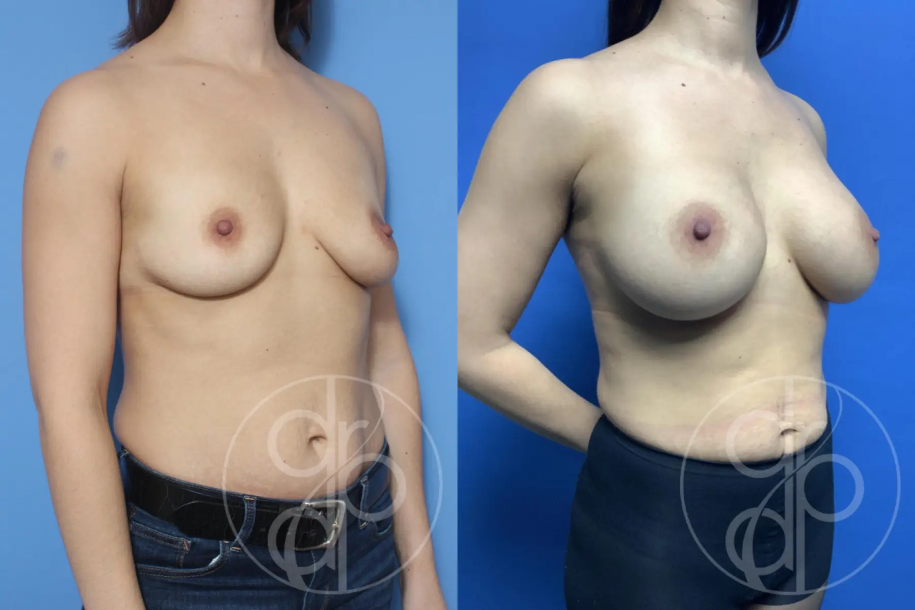 patient 10291 breast augmentation before and after result - Before and After 2