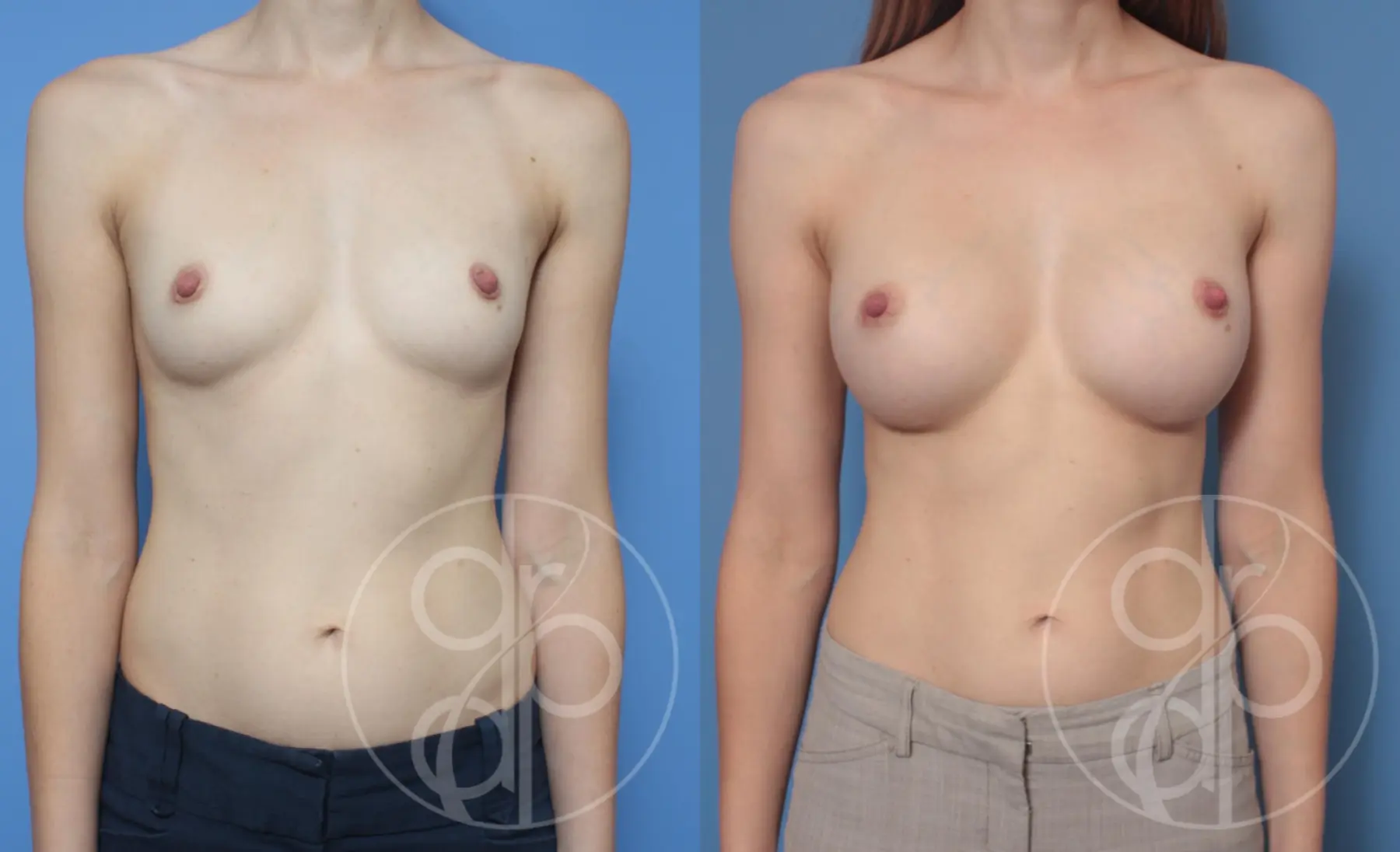 patient 10433 breast augmentation before and after result - Before and After 1