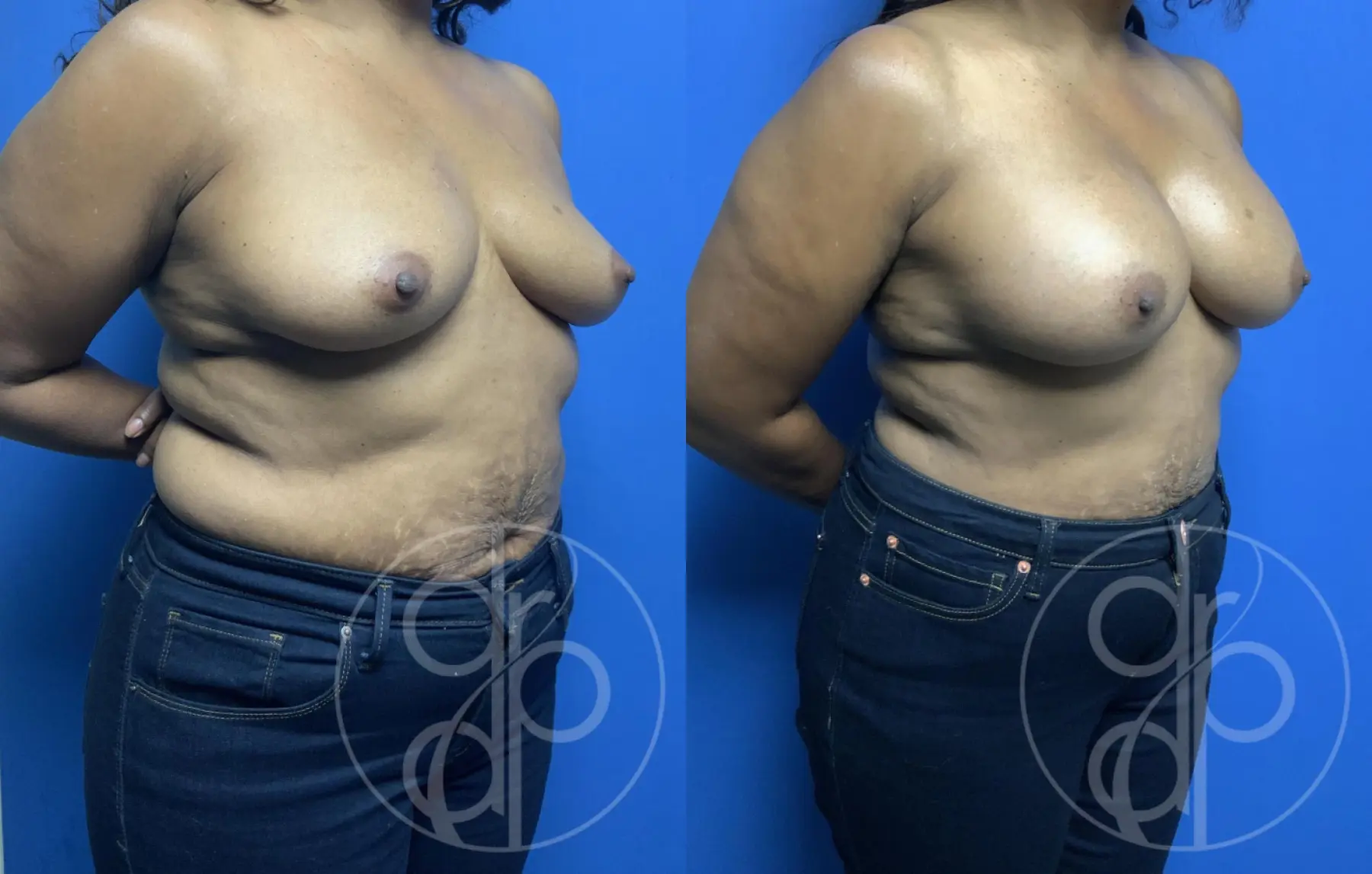 patient 12345 breast augmentation before and after result - Before and After 2