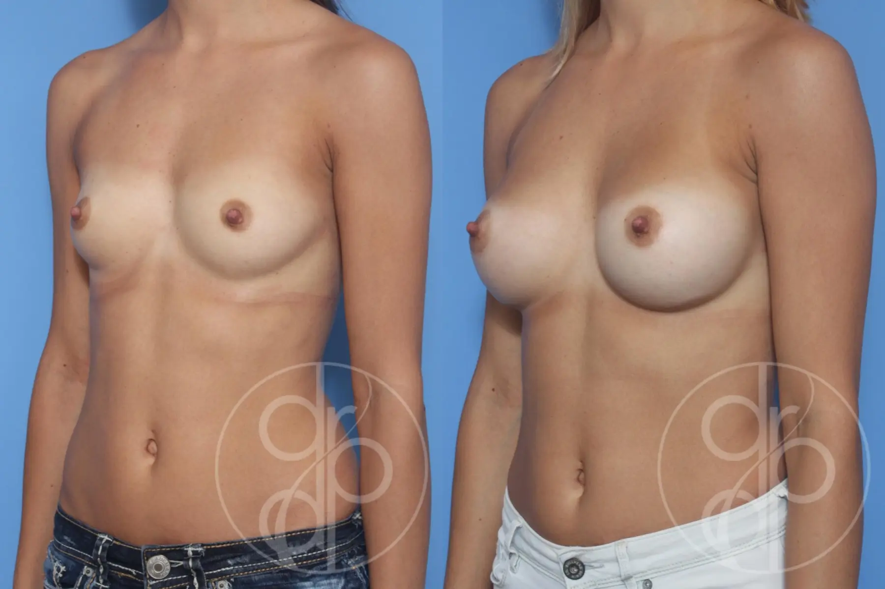 patient 13016 breast augmentation before and after result - Before and After 3