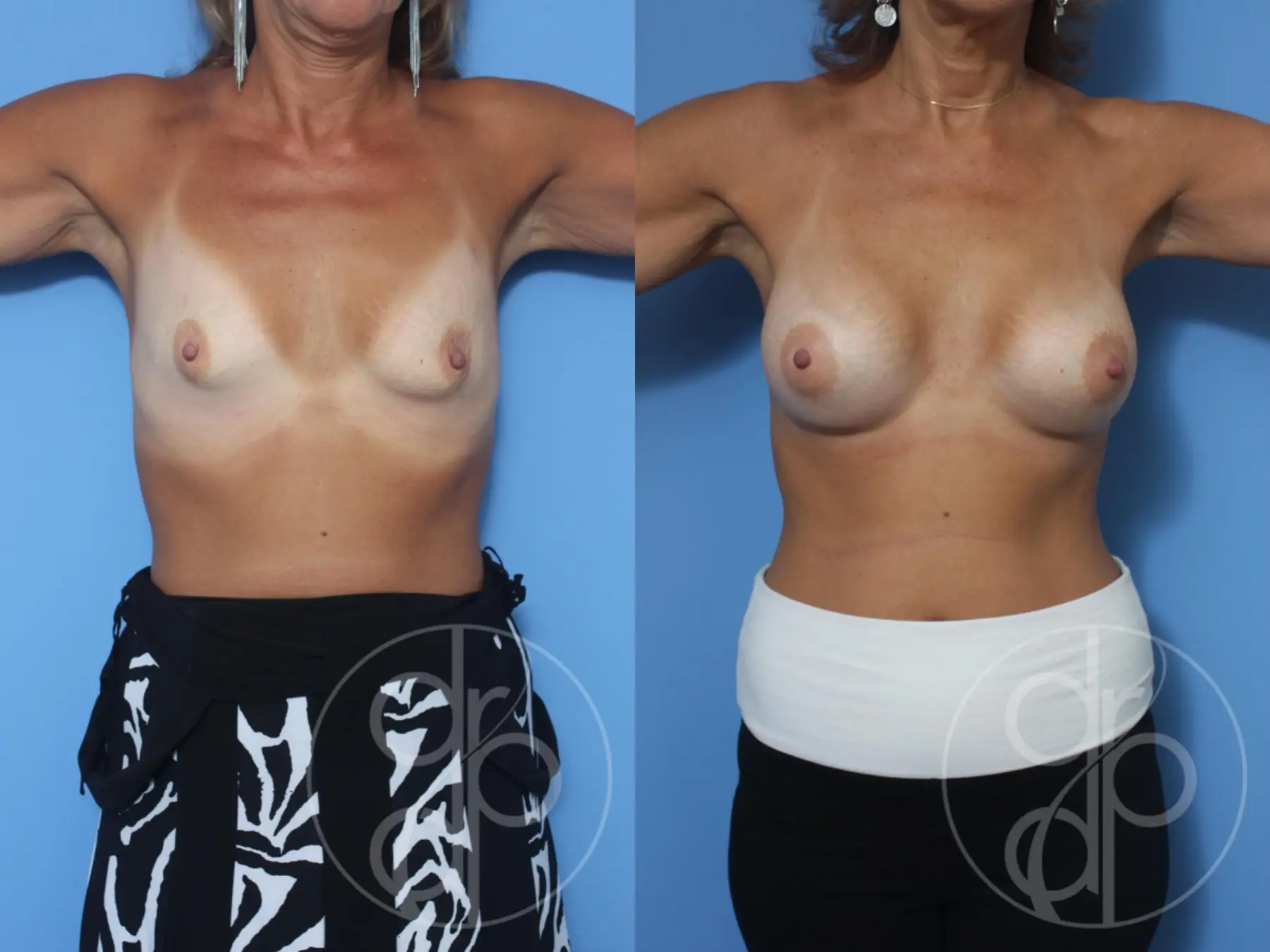 patient 13088 breast augmentation before and after result - Before and After 2