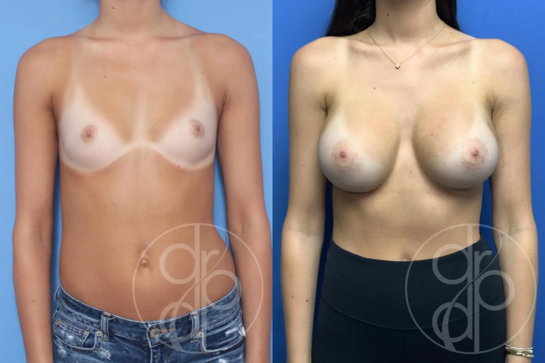 patient 12441 breast augmentation before and after result - Before and After 1