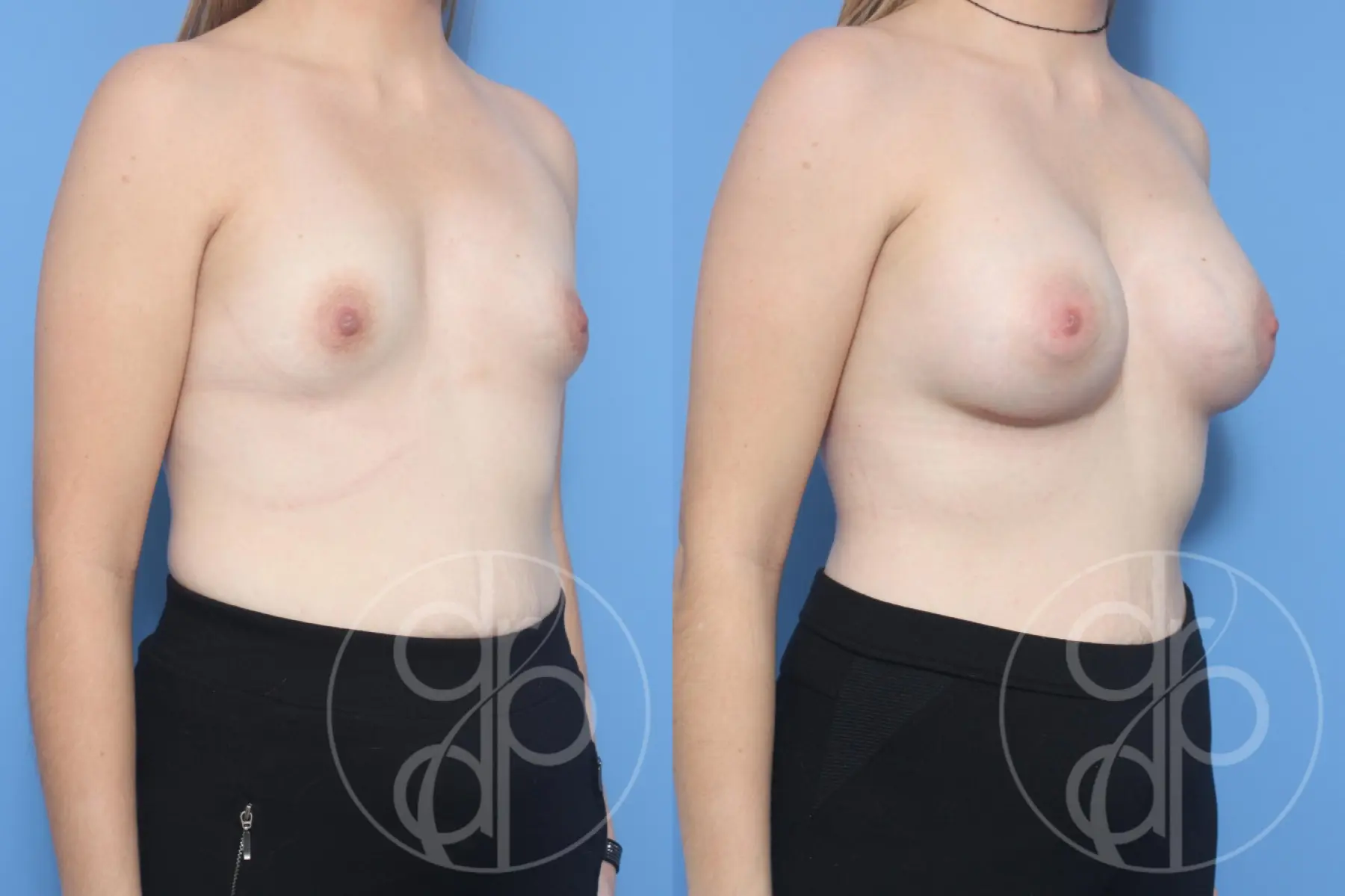patient 13235 breast augmentation before and after result - Before and After 2