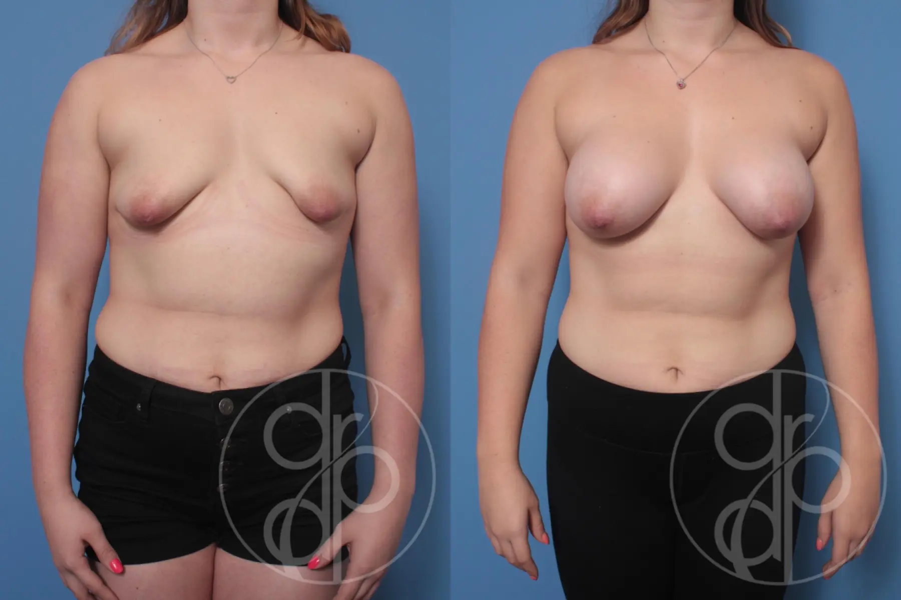 patient 10234 breast augmentation before and after result - Before and After 1