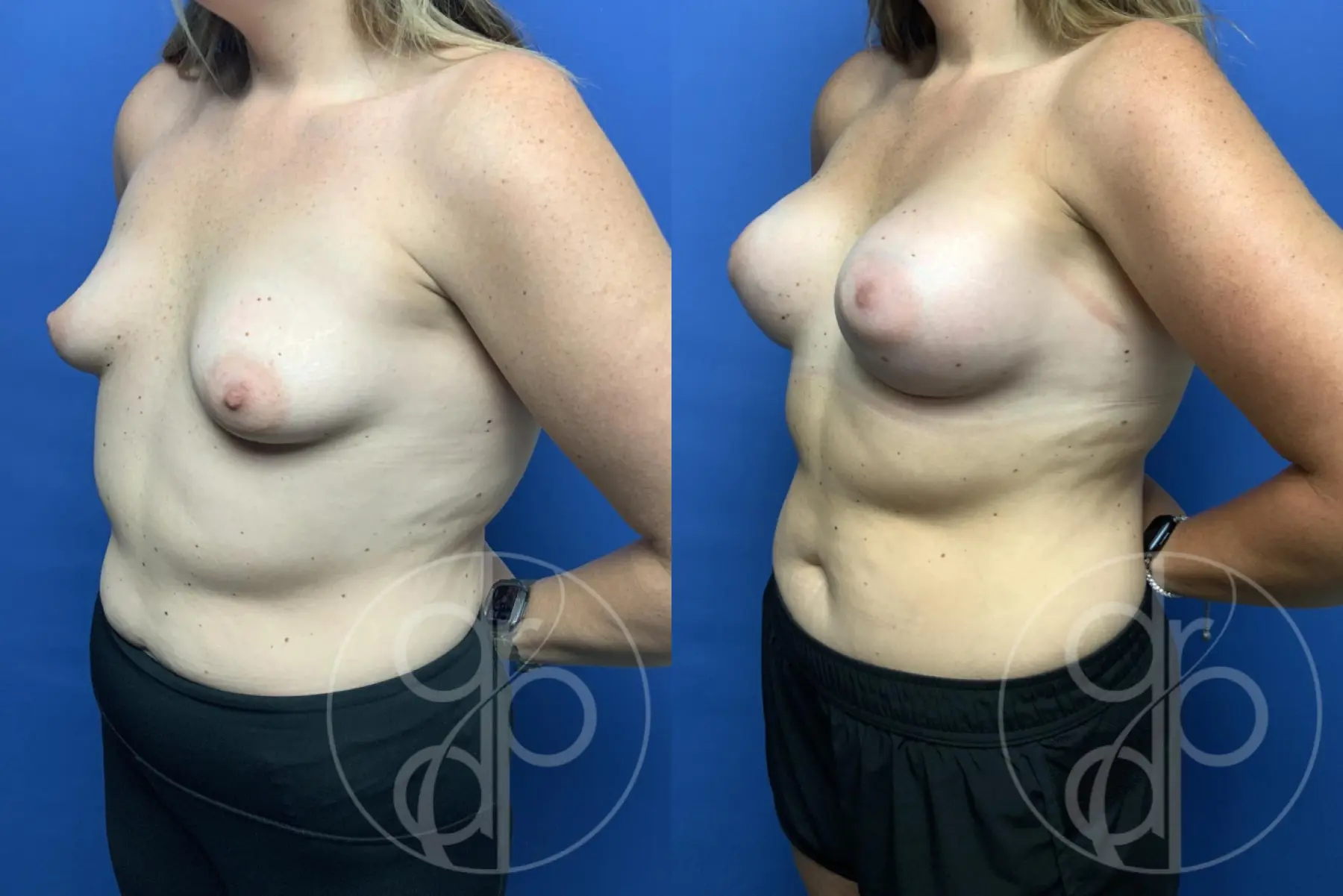 patient 12207 breast augmentation before and after result - Before and After 3