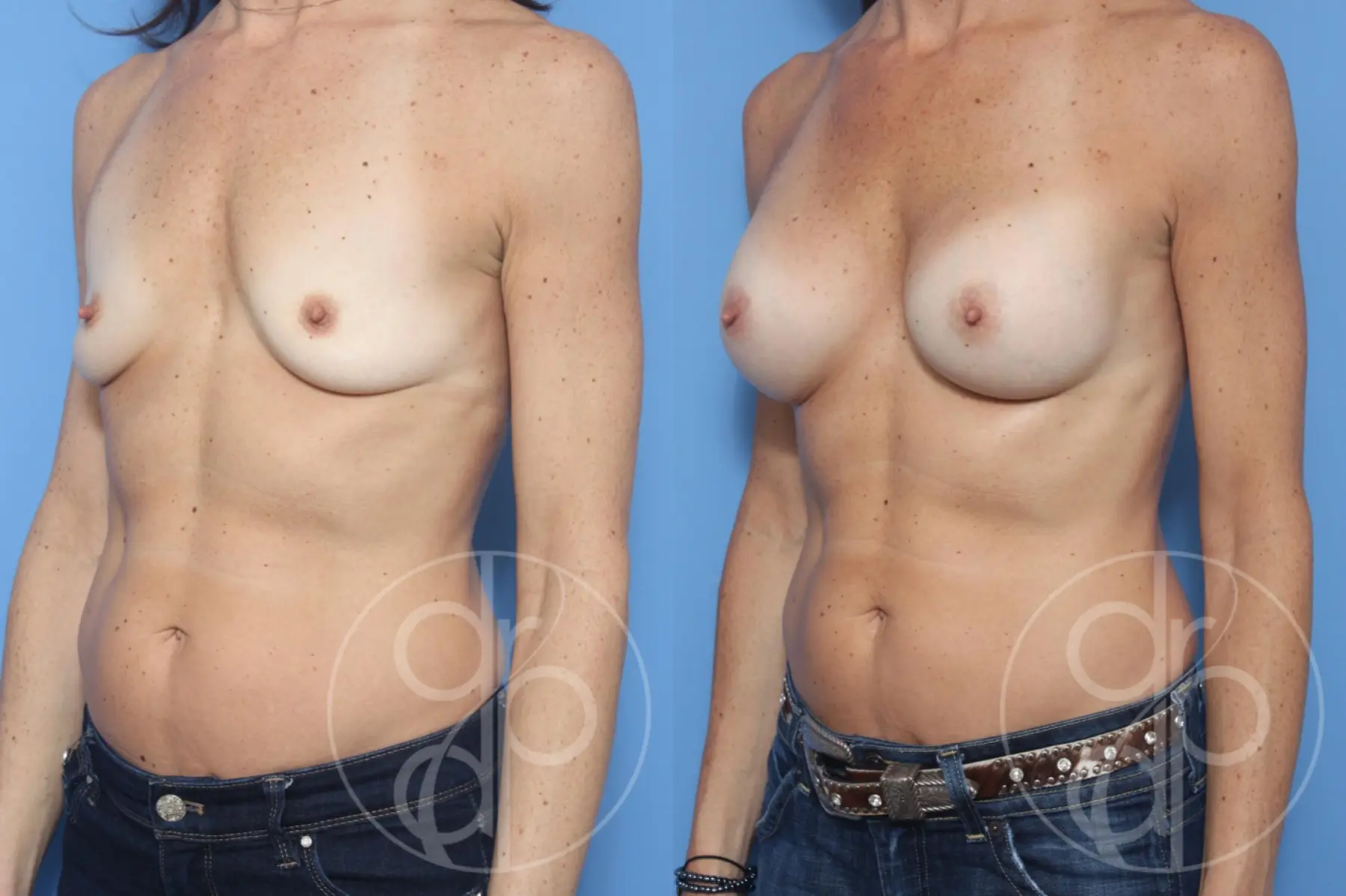 patient 10383 breast augmentation before and after result - Before and After 3