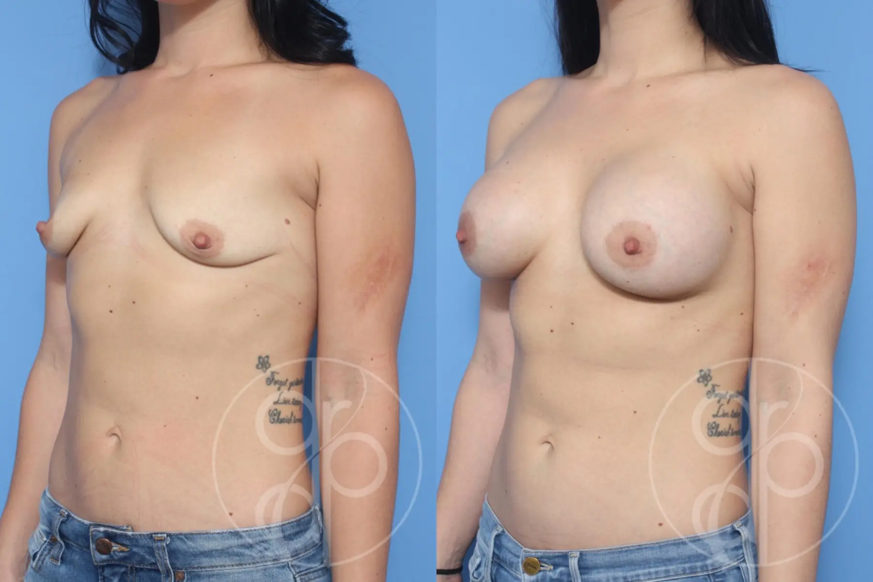 patient 13035 breast augmentation before and after result - Before and After 2
