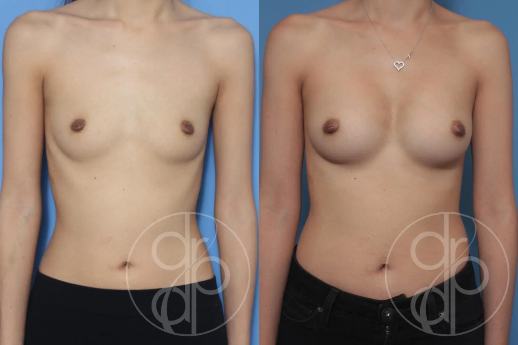 patient 10532 breast augmentation before and after result - Before and After 1