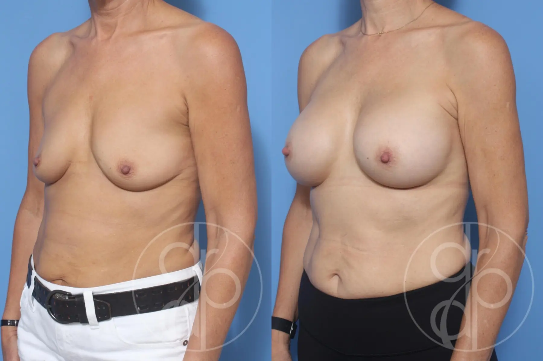 patient 10750 breast augmentation before and after result - Before and After 3