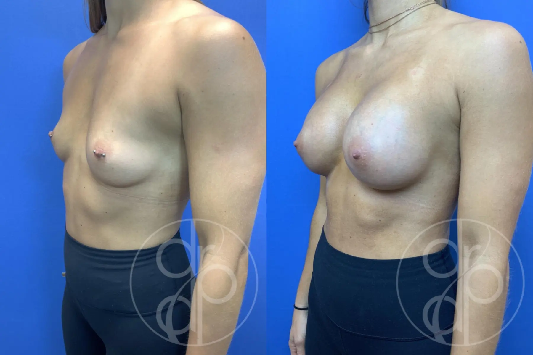 patient 10795 breast augmentation before and after result - Before and After 3