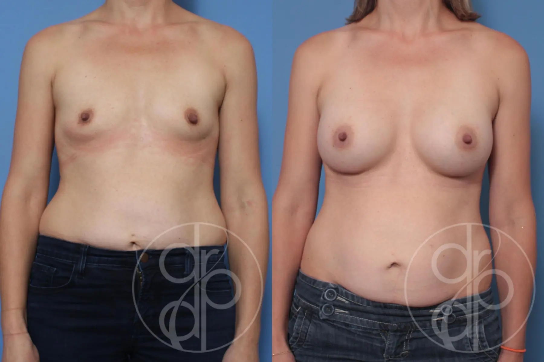 Breast Augmentation: Patient 7 - Before and After  