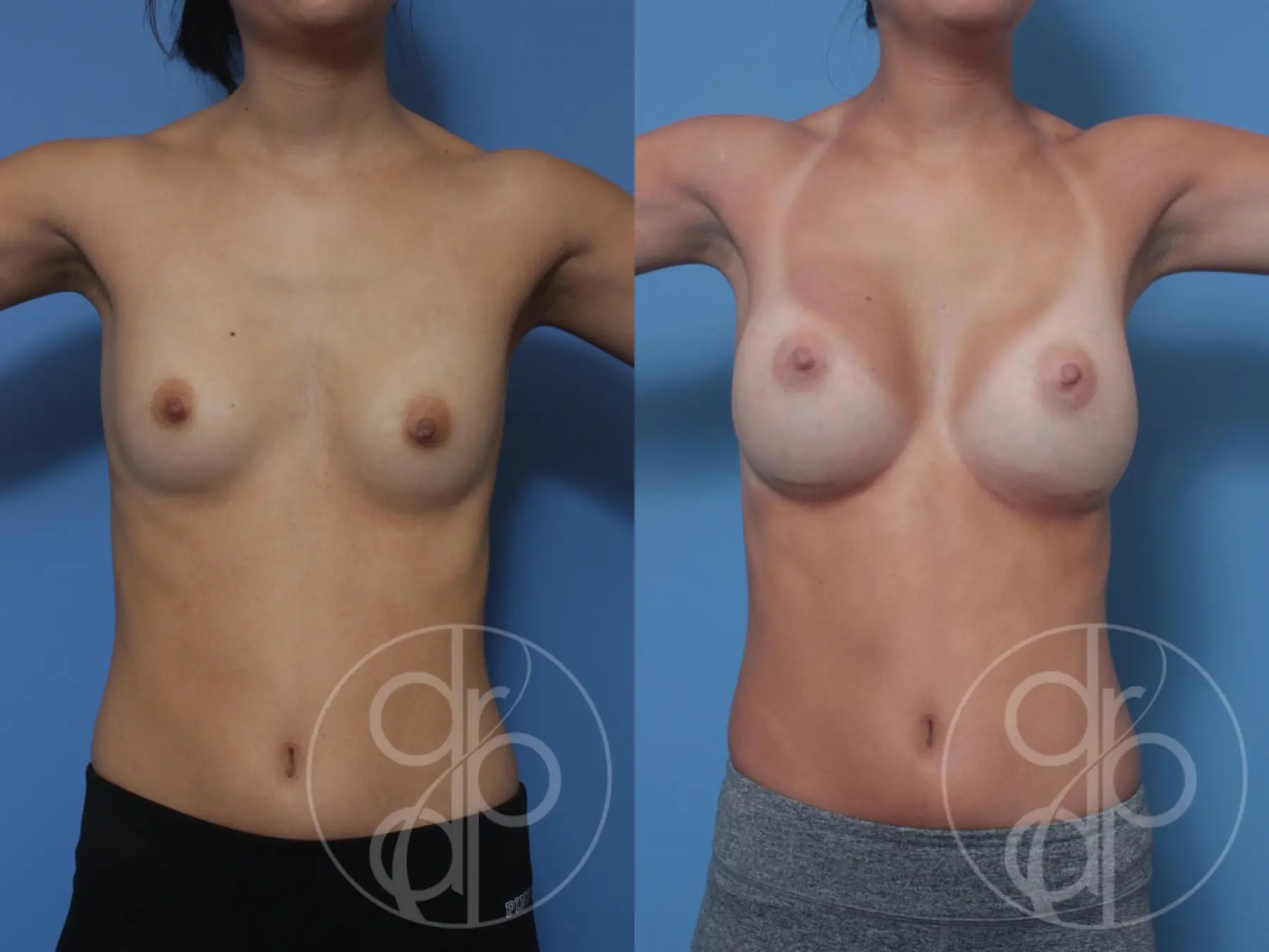 patient 10303 breast augmentation before and after result - Before and After 2