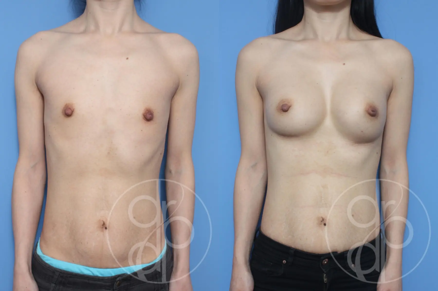 patient 10537 breast augmentation before and after result - Before and After