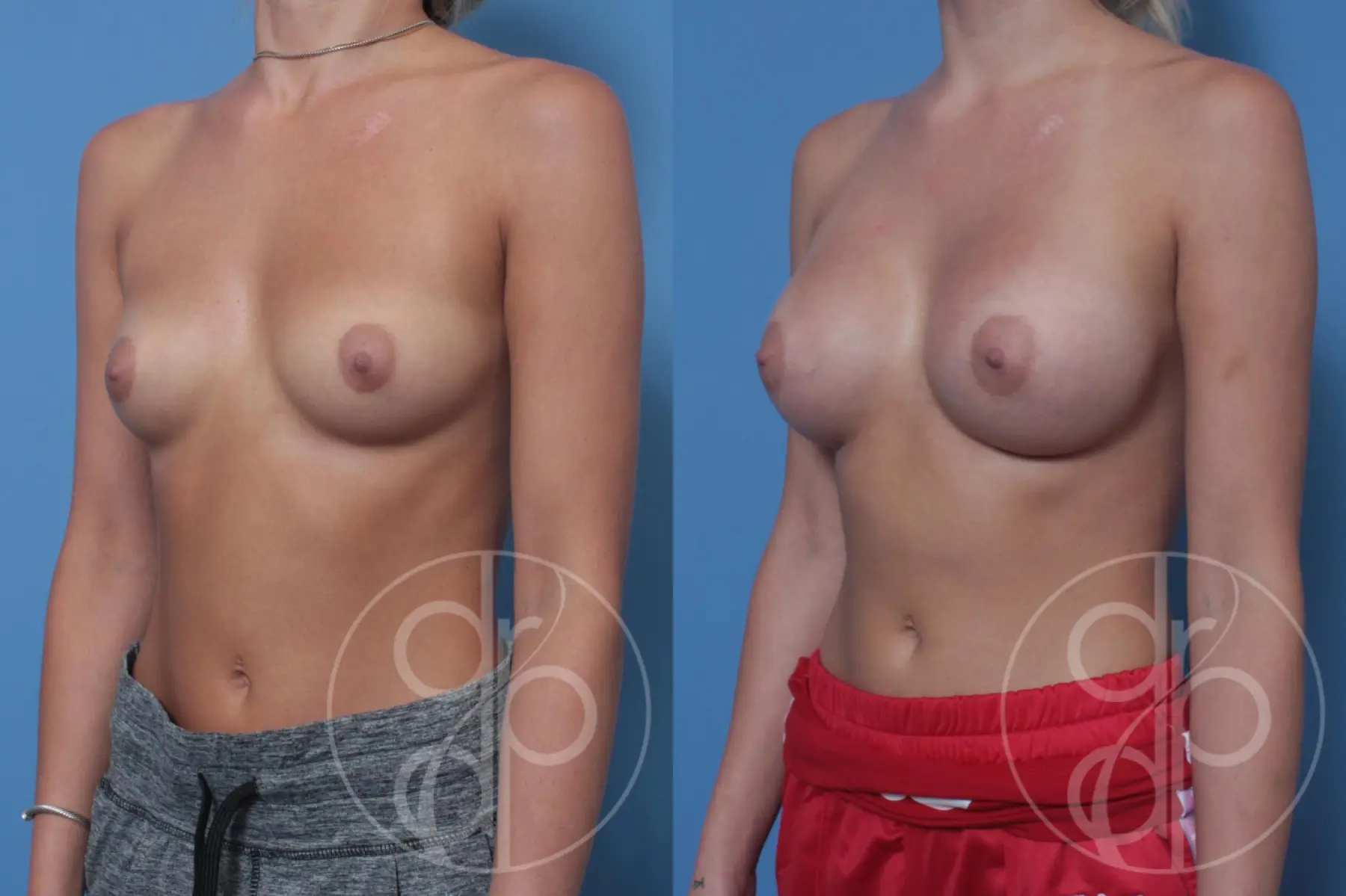 patient 10573 breast augmentation before and after result - Before and After 3