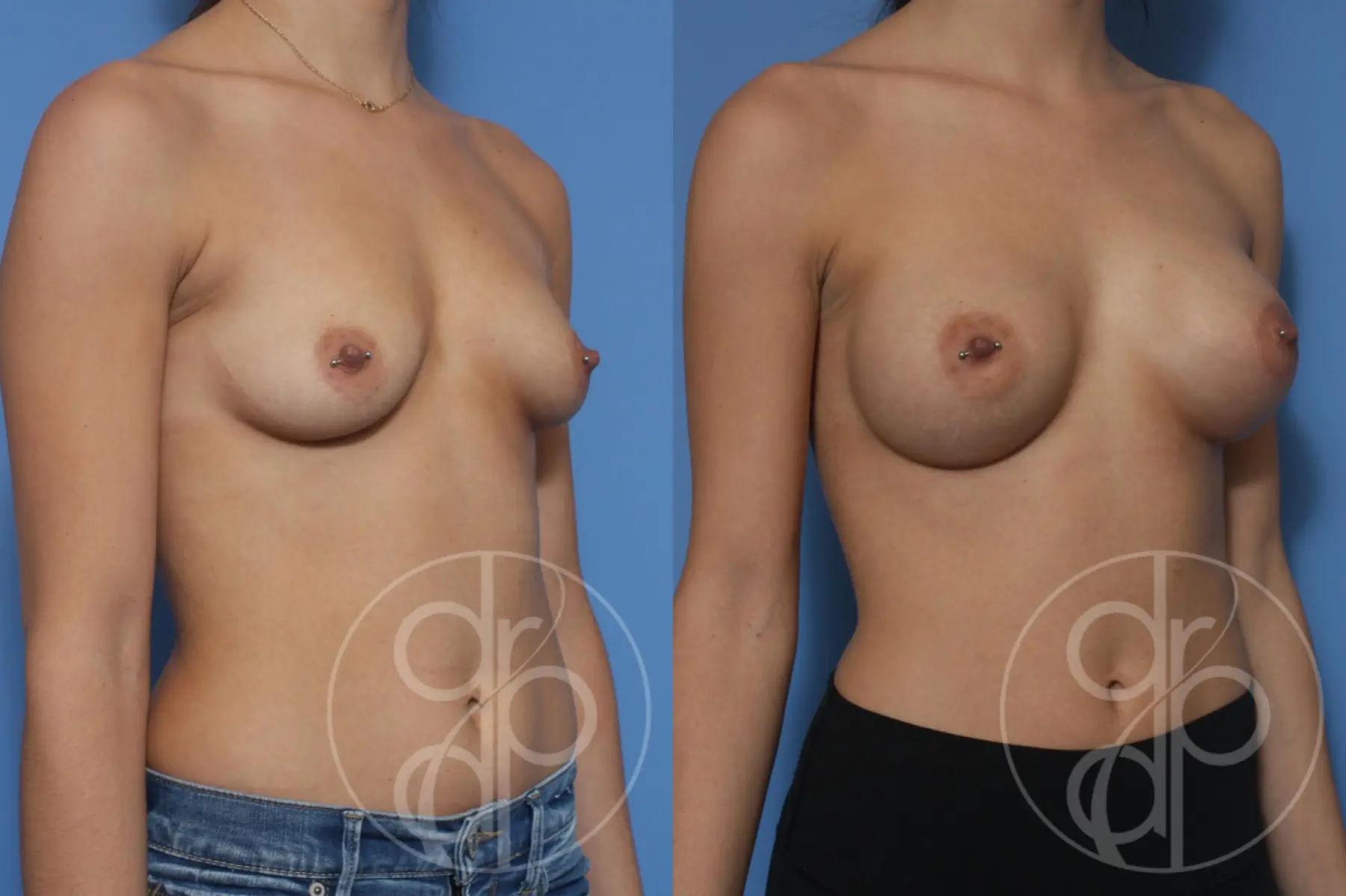 patient 10277 breast augmentation before and after result - Before and After 3
