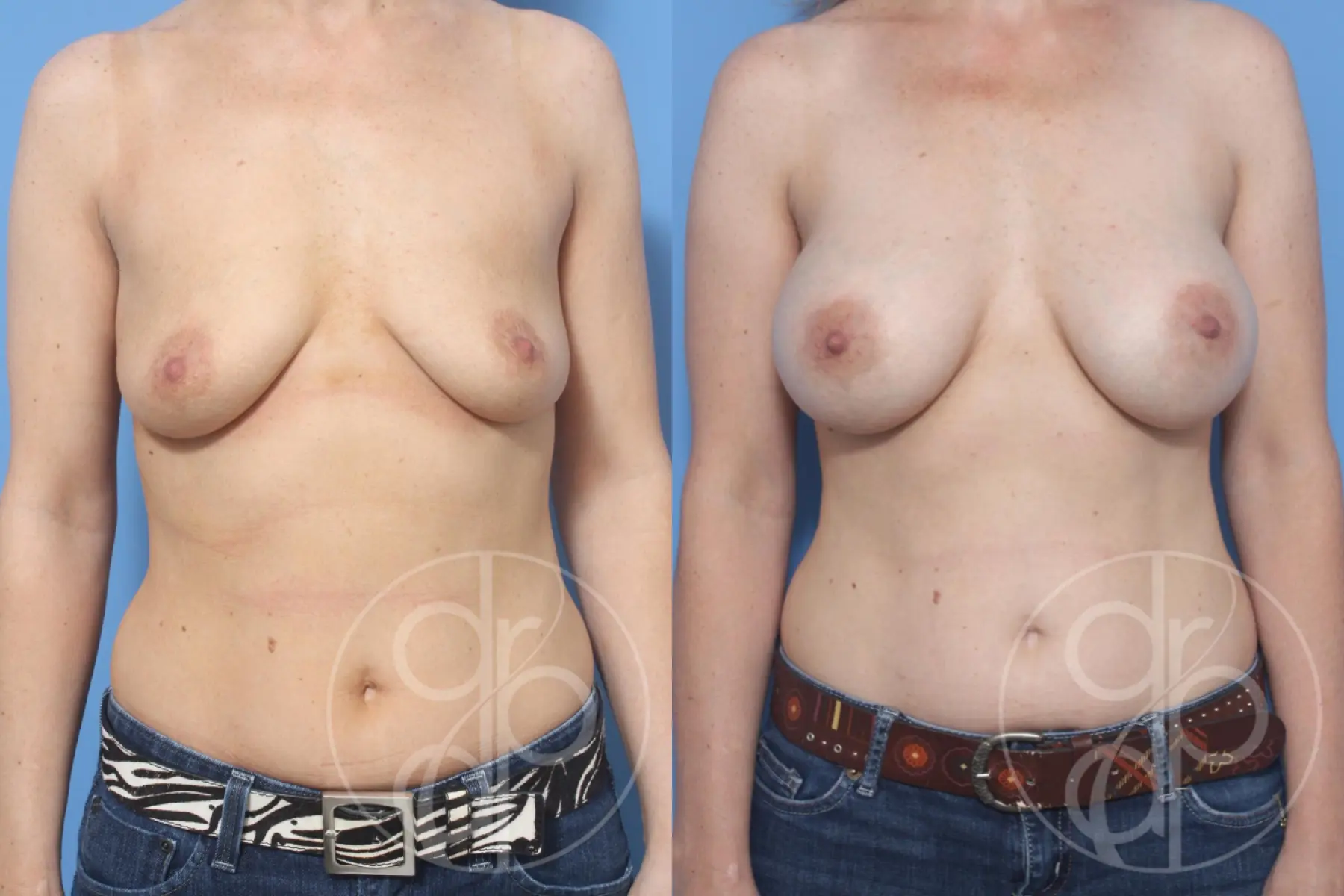 patient 12899 breast augmentation before and after result - Before and After 1