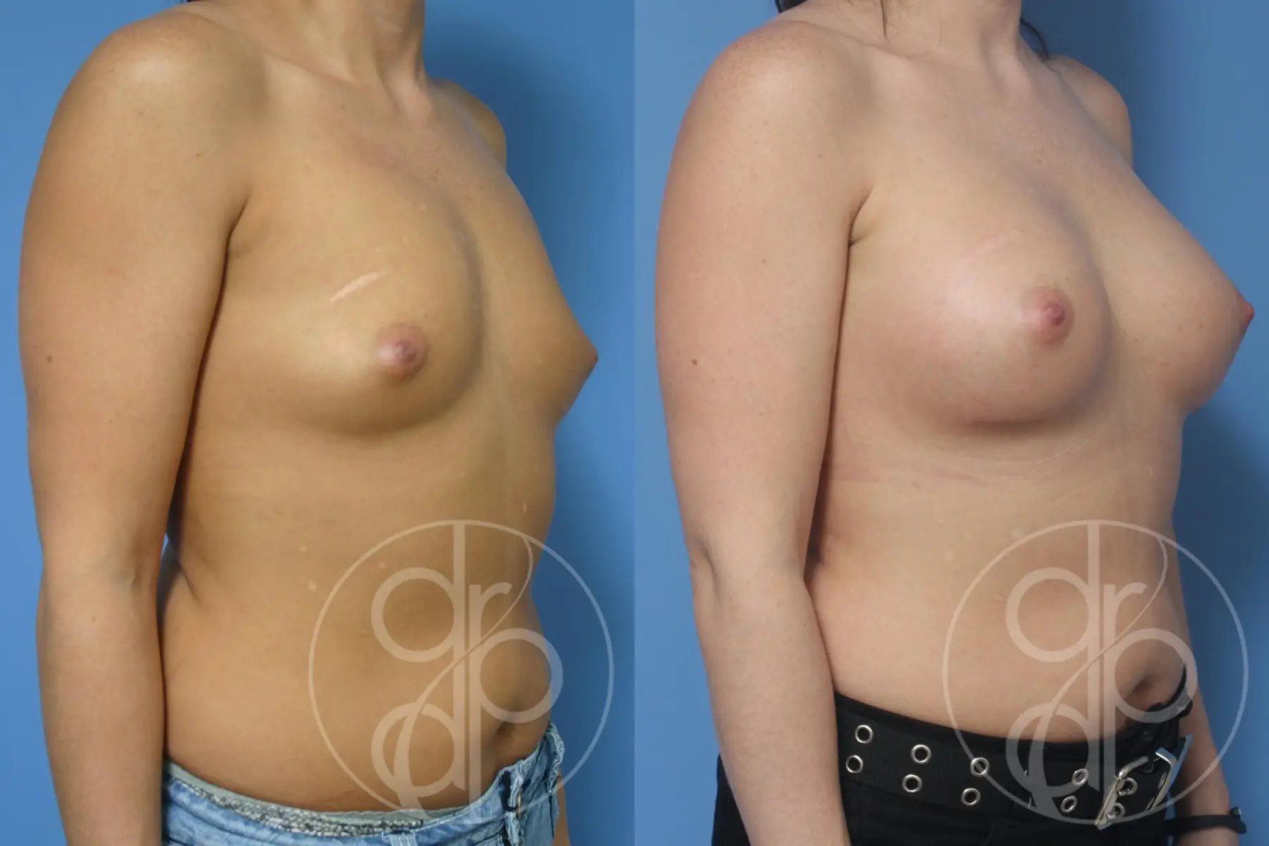 patient 13054 breast augmentation before and after result - Before and After 2