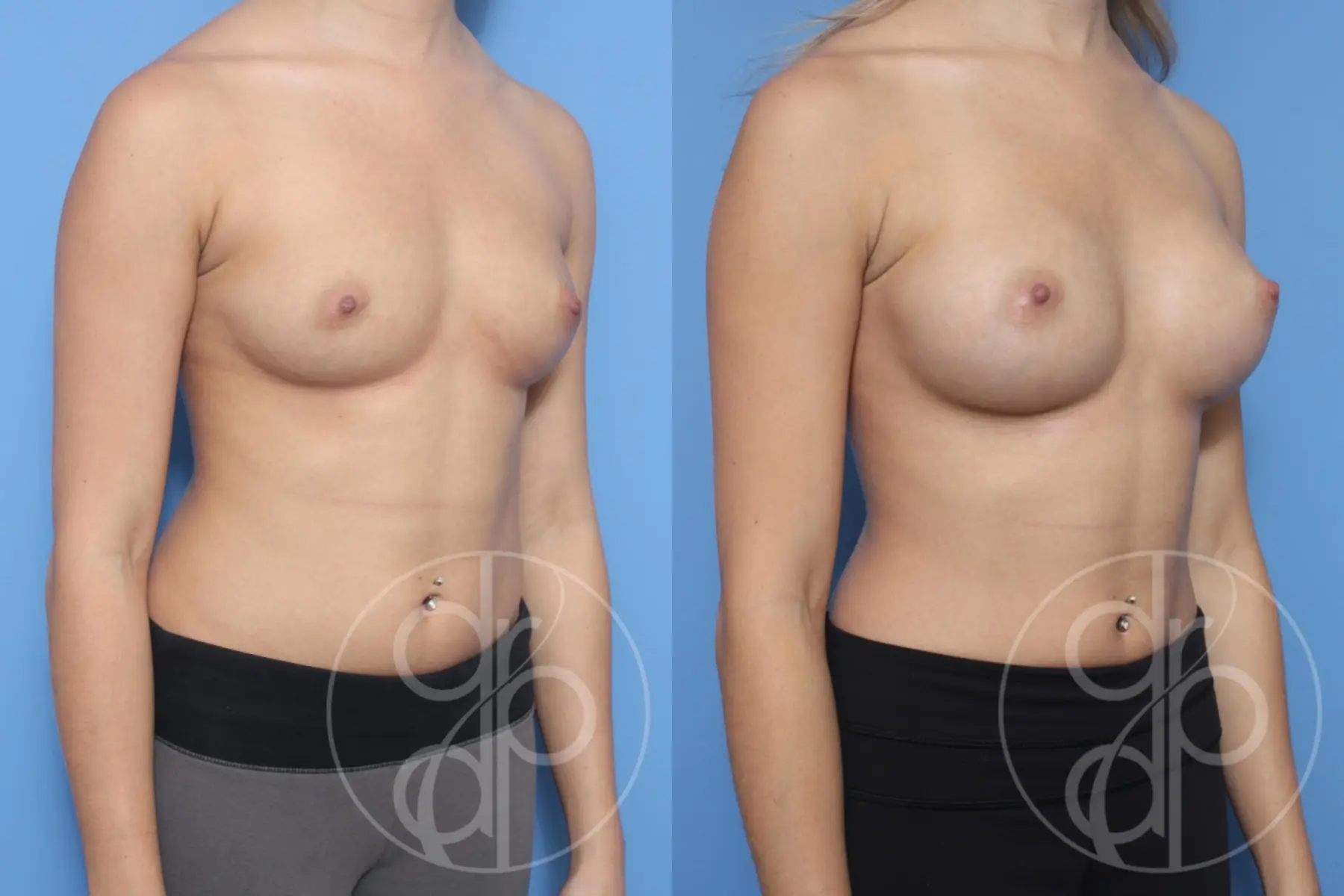 patient 12591 breast augmentation before and after result - Before and After 2