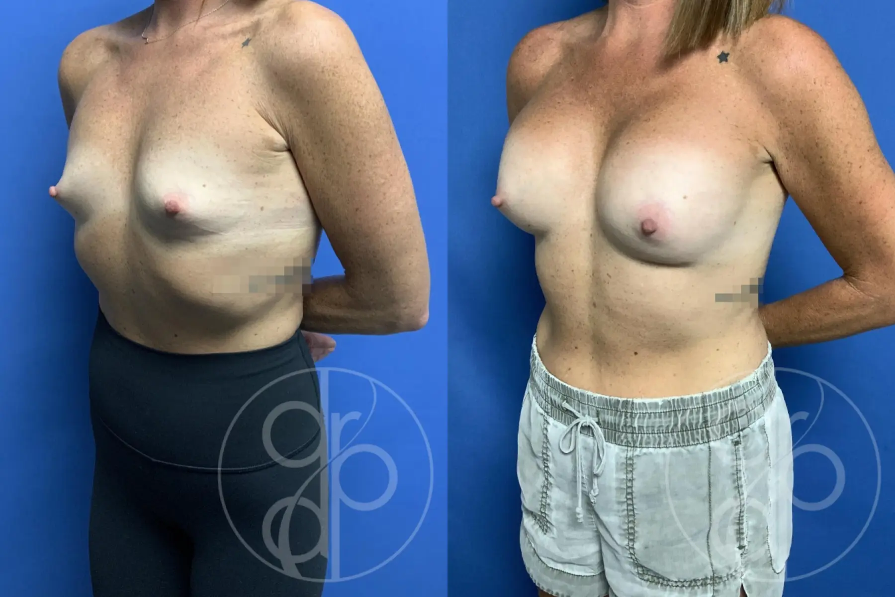 patient 13396 breast augmentation before and after result - Before and After 3