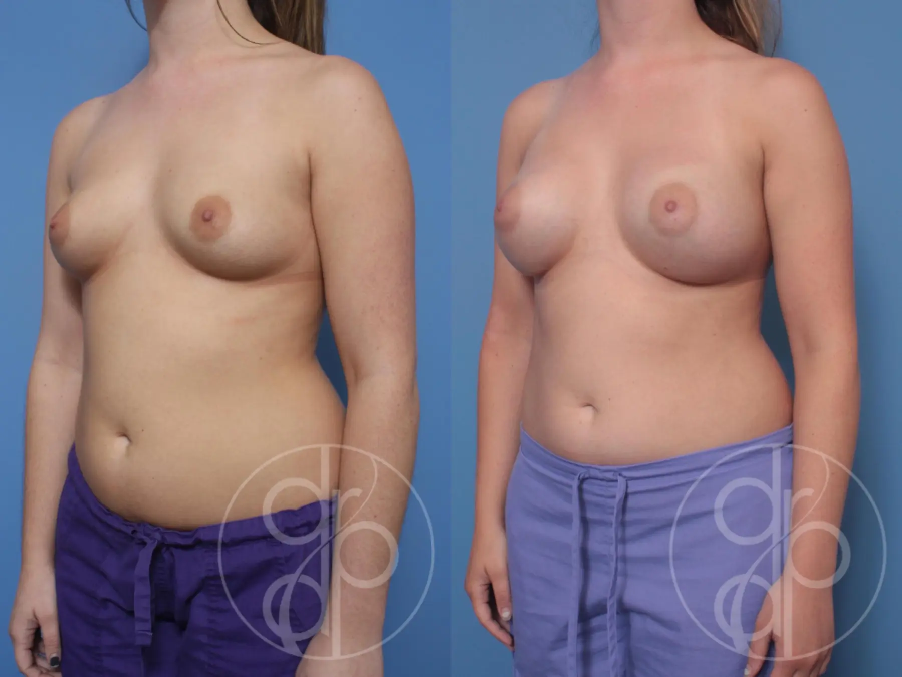 patient 10121 breast augmentation before and after result - Before and After 3
