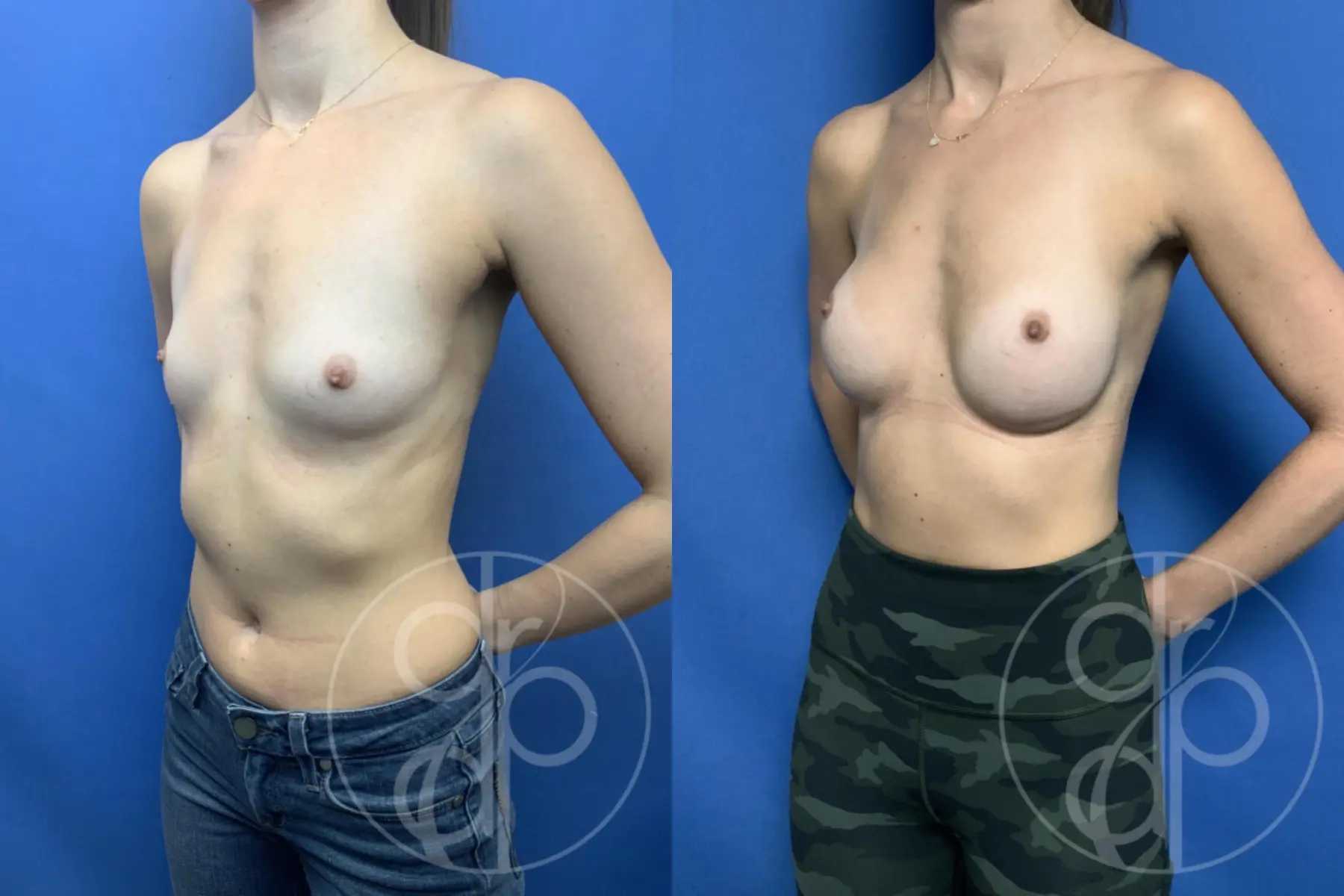 patient 10787 breast augmentation before and after result - Before and After 3
