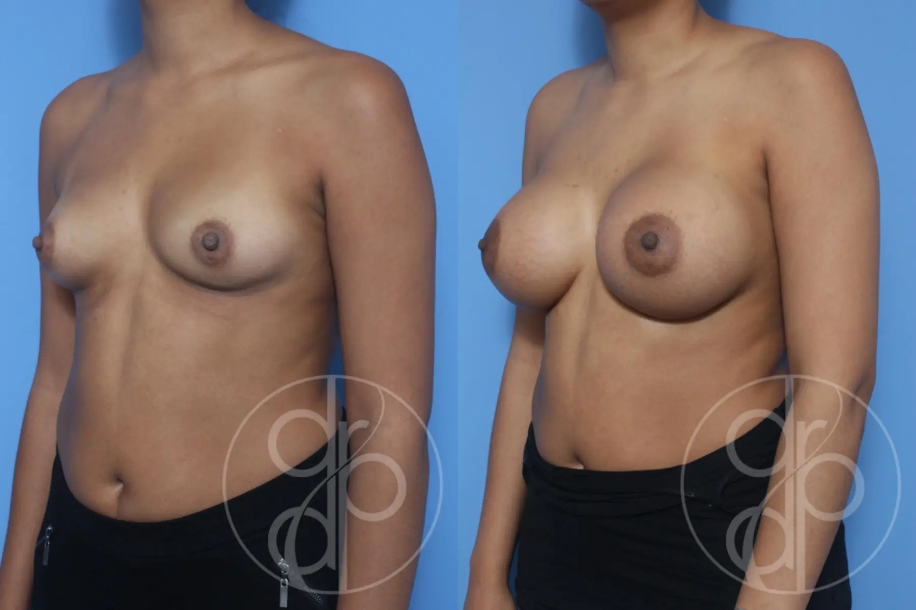 patient 10131 breast augmentation before and after result - Before and After 2