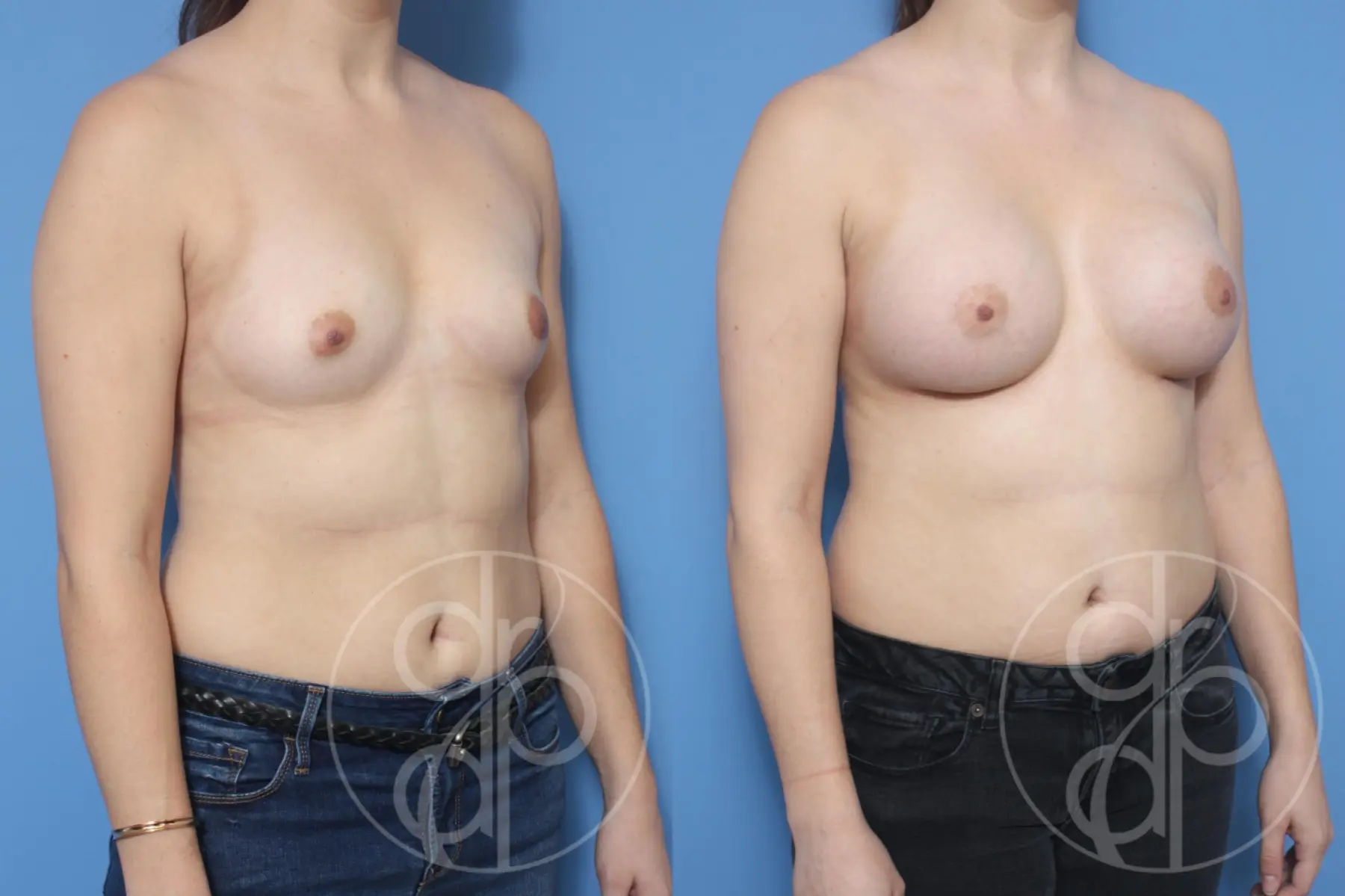 patient 13306 breast augmentation before and after result - Before and After 2
