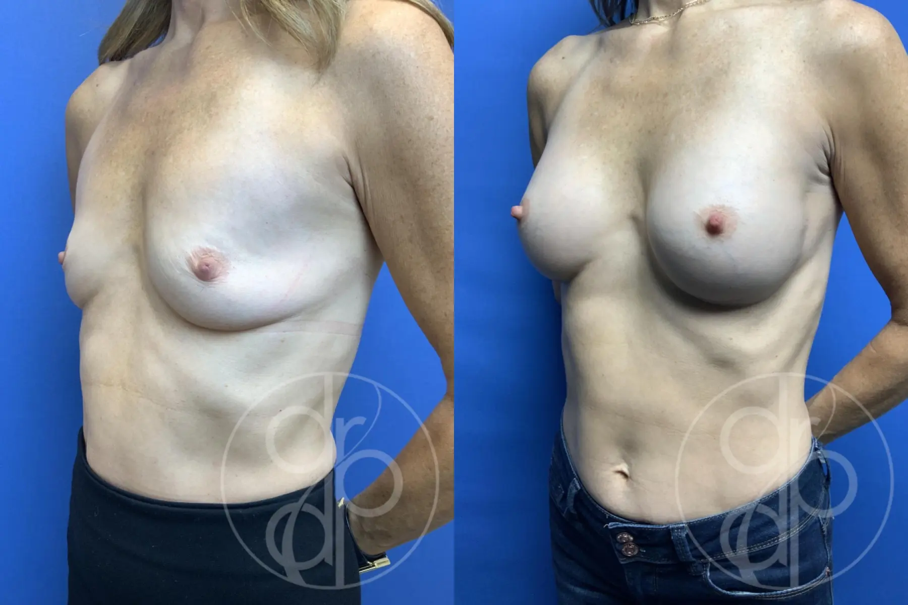 patient 11922 breast augmentation before and after result - Before and After 3