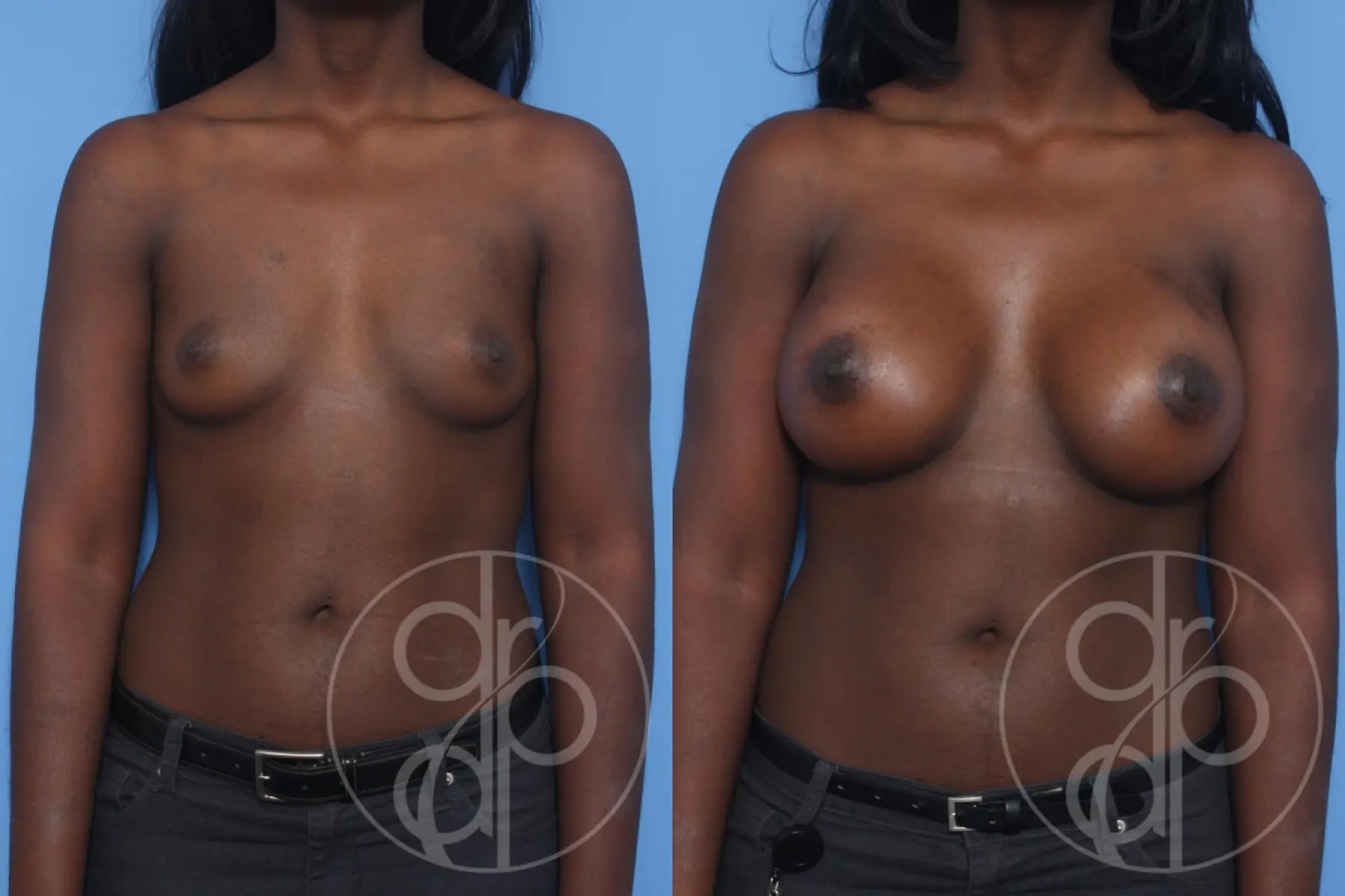 patient 12947 breast augmentation before and after result - Before and After 1