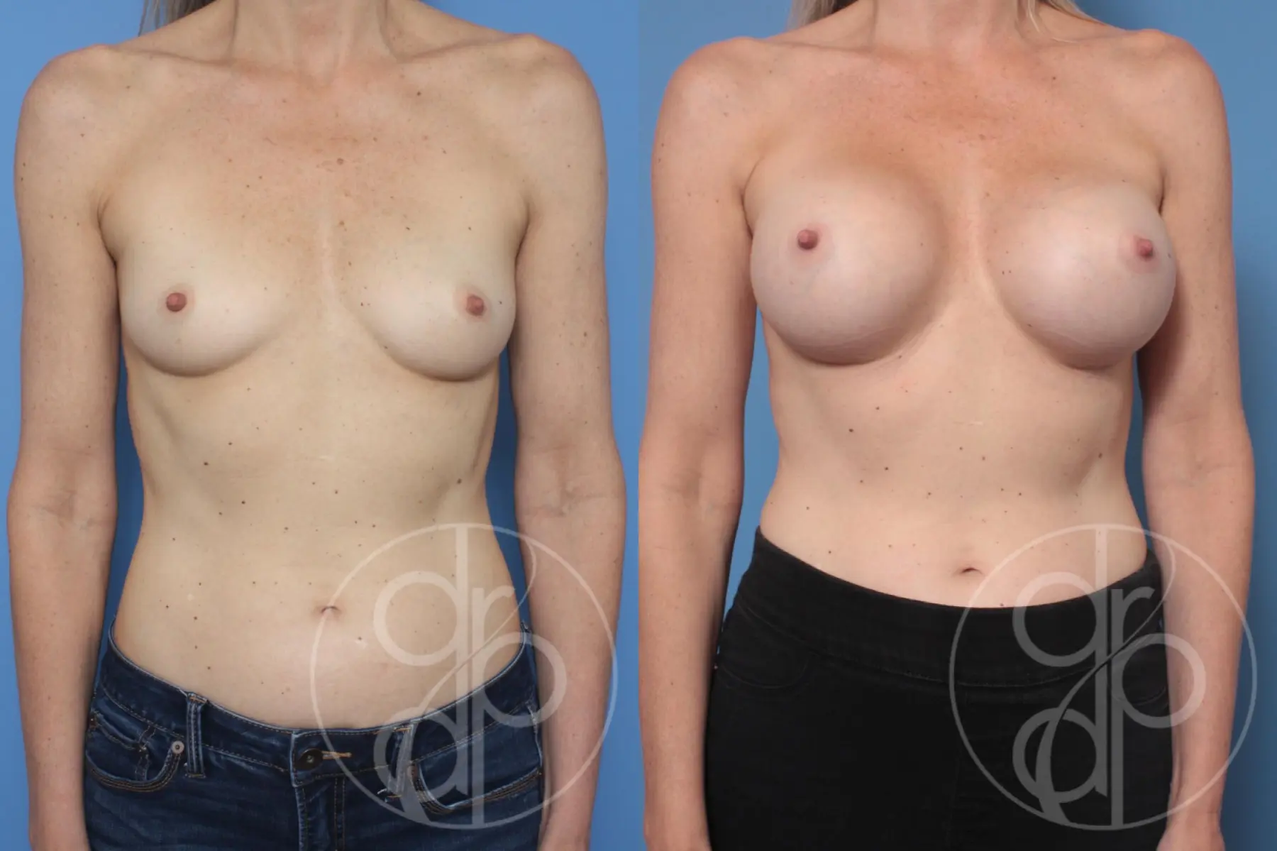 patient 10351 breast augmentation before and after result - Before and After 1