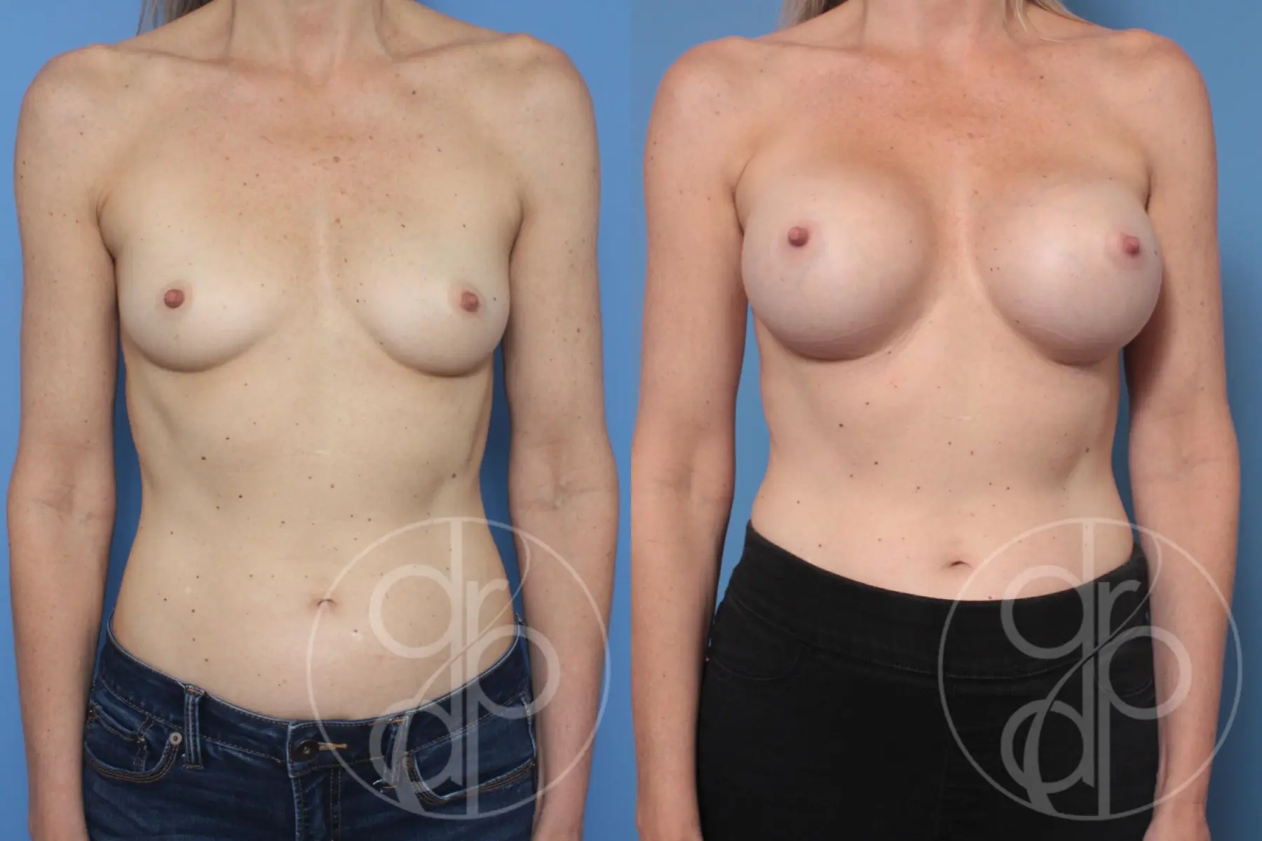 patient 10351 breast augmentation before and after result - Before and After