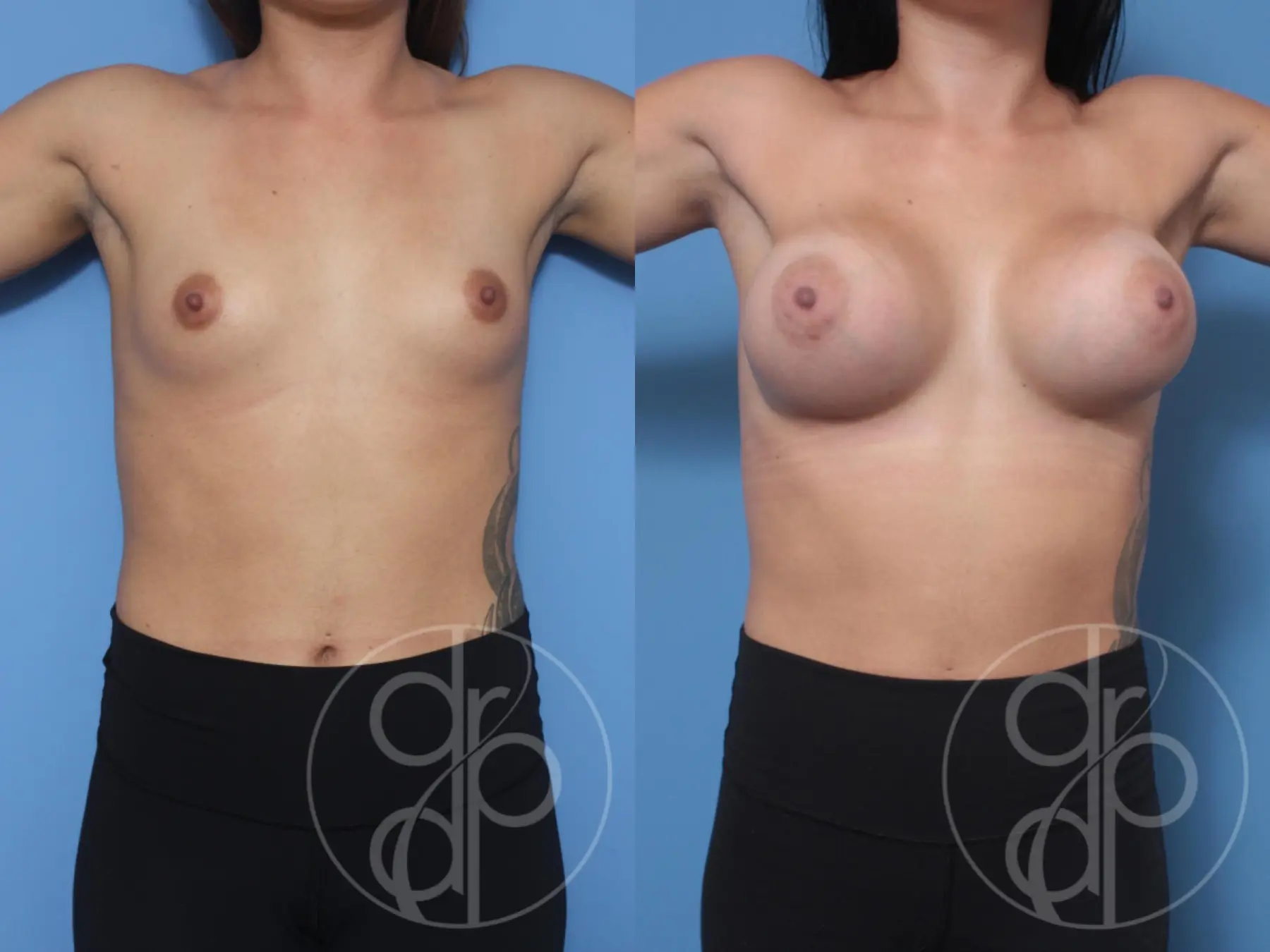 patient 10289 breast augmentation before and after result - Before and After 2