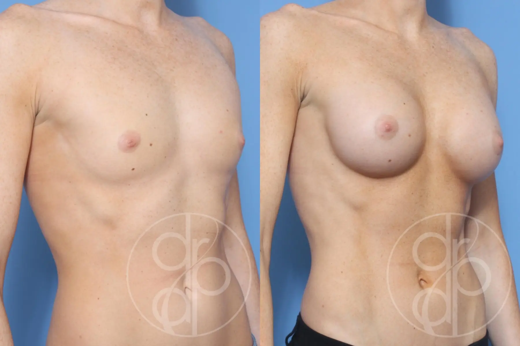 patient 11885 breast augmentation before and after result - Before and After 2