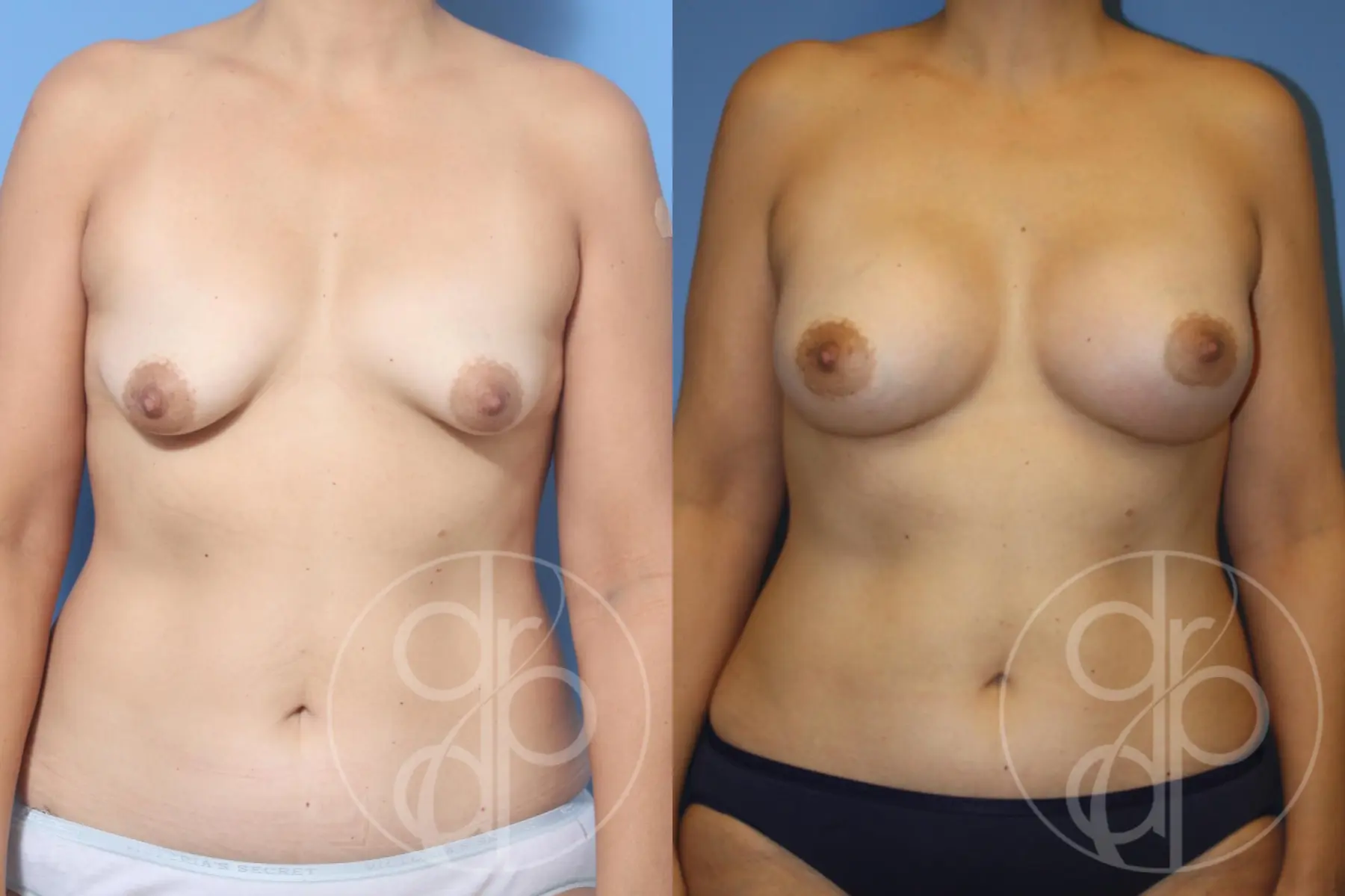 patient 12812 breast augmentation before and after result - Before and After 1