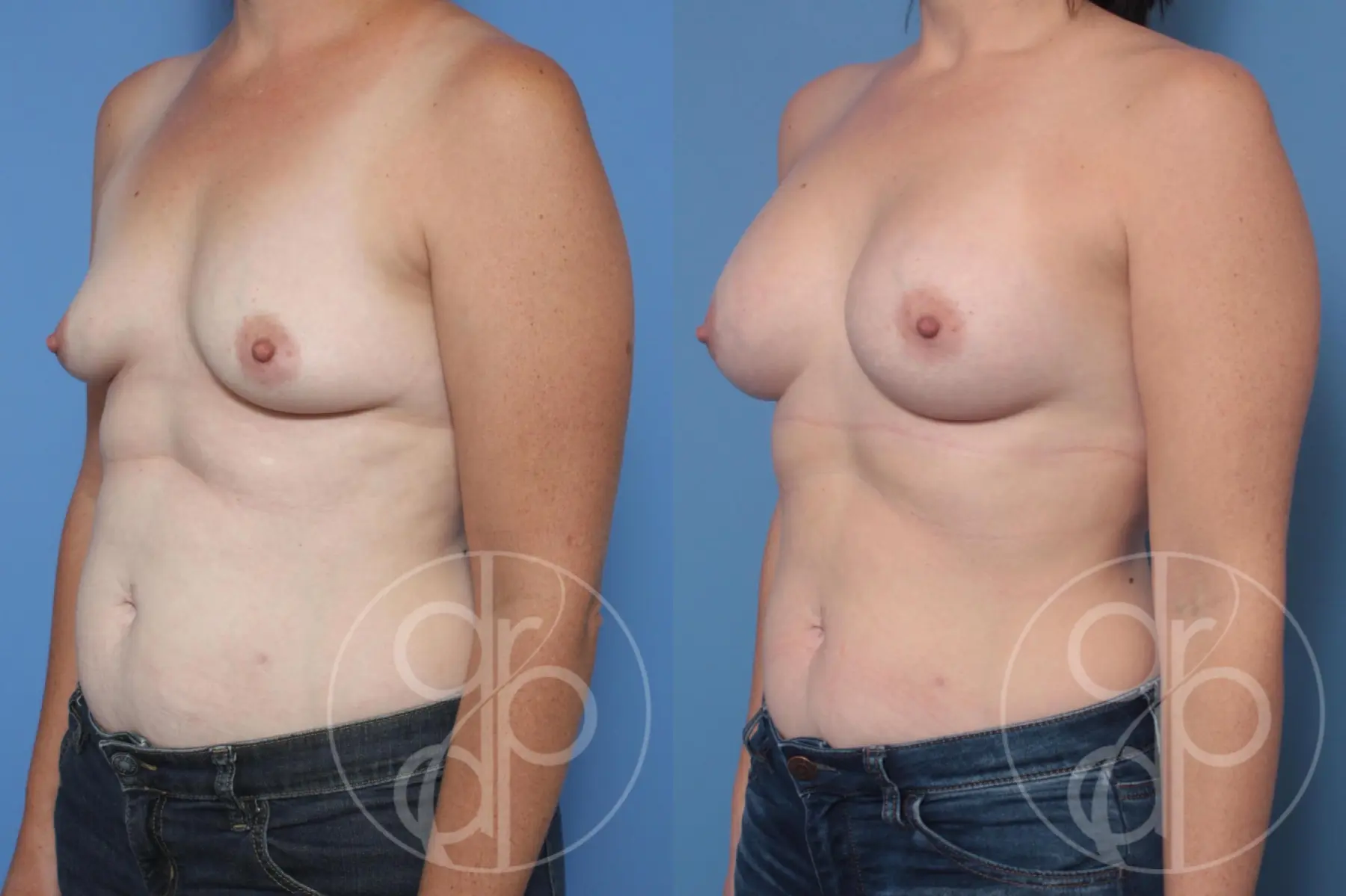 Breast Augmentation: Patient 91 - Before and After 4
