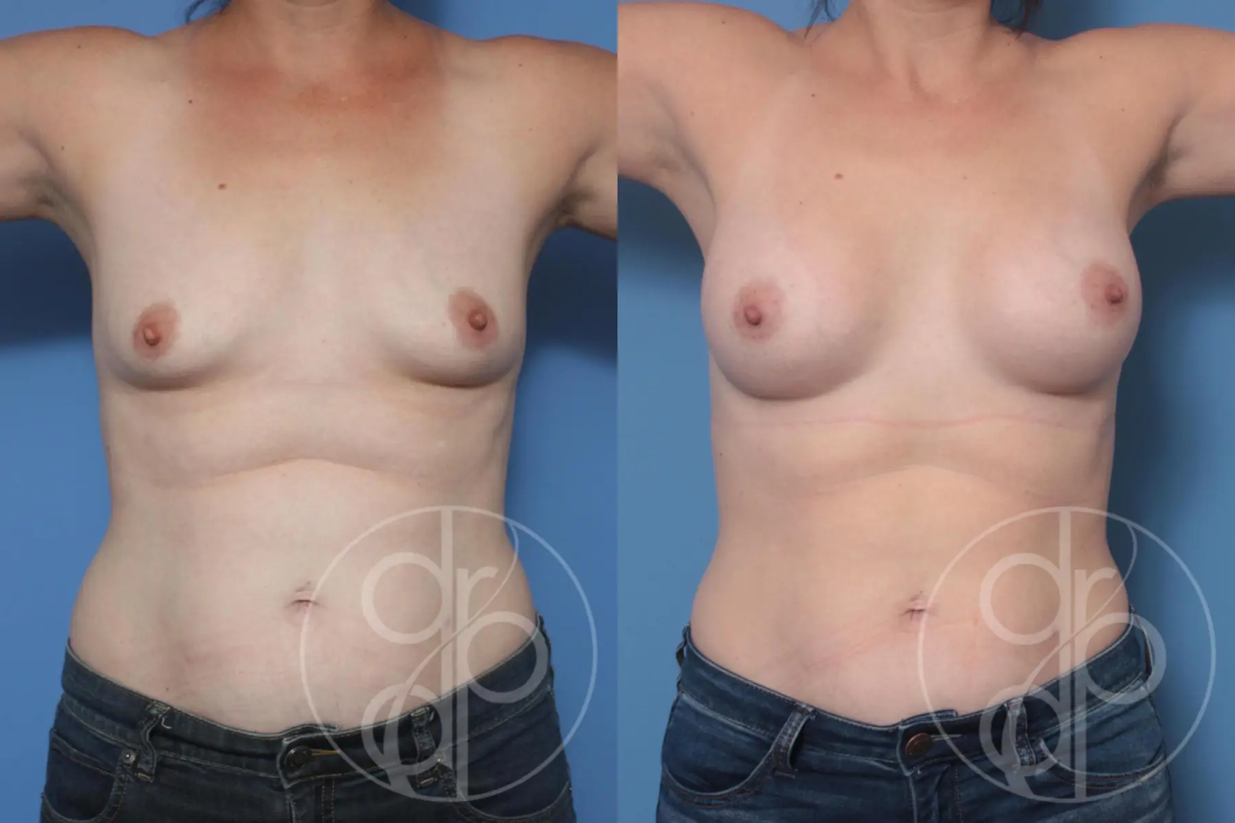 Breast Augmentation: Patient 91 - Before and After 2
